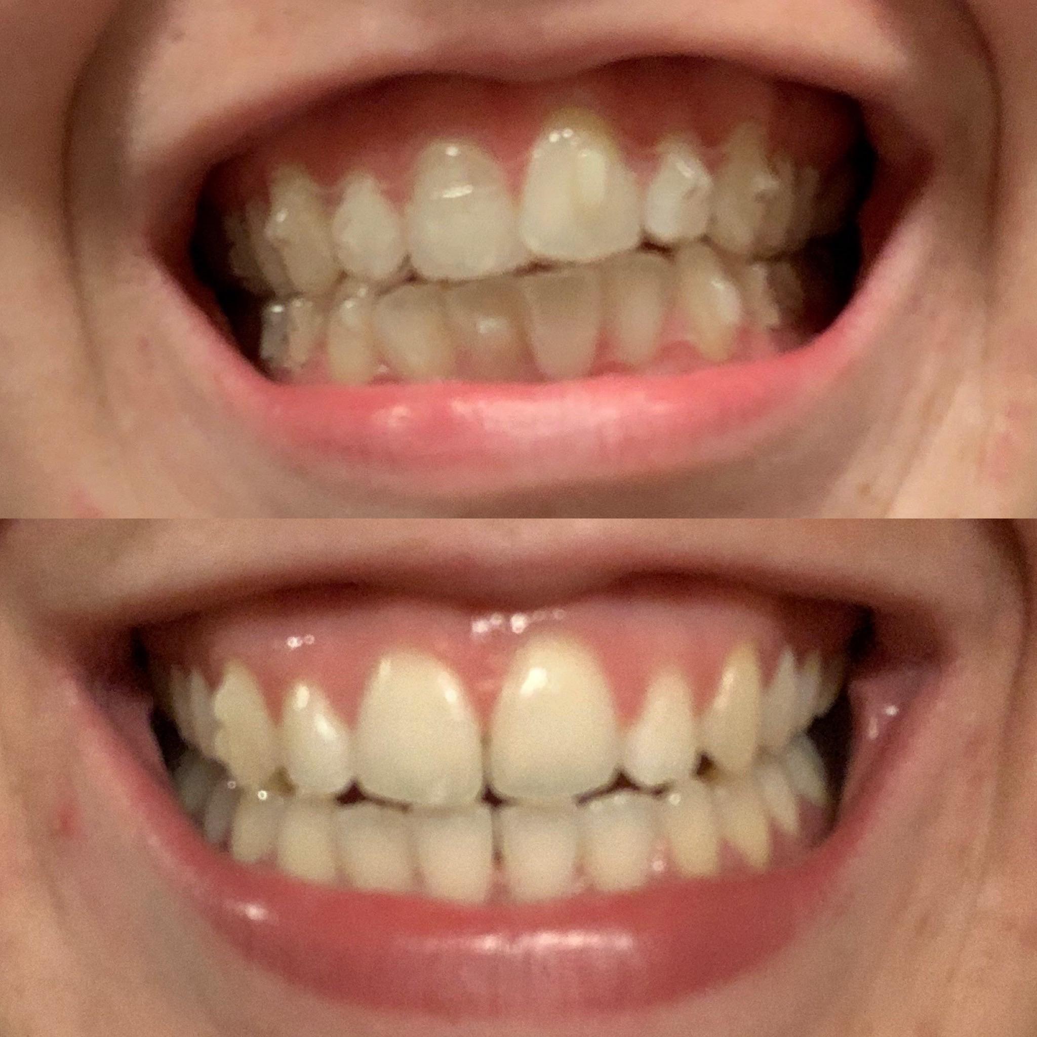 Invisalign How old do you need to be for Invisalign clear aligners?