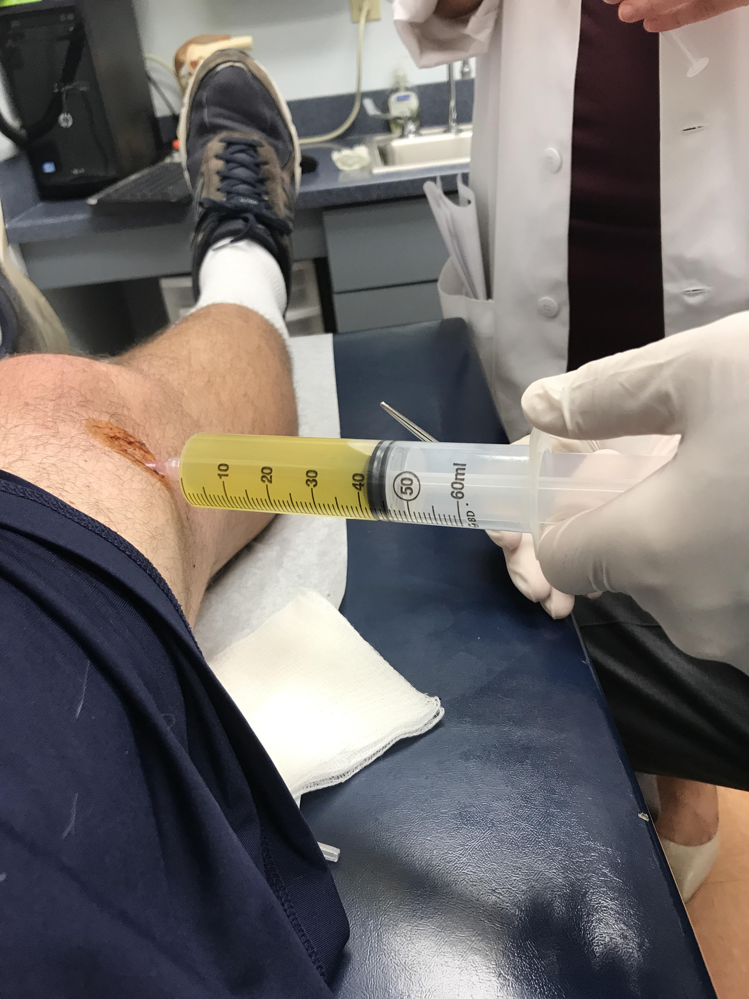 Knee fluid drained KneeInjuries