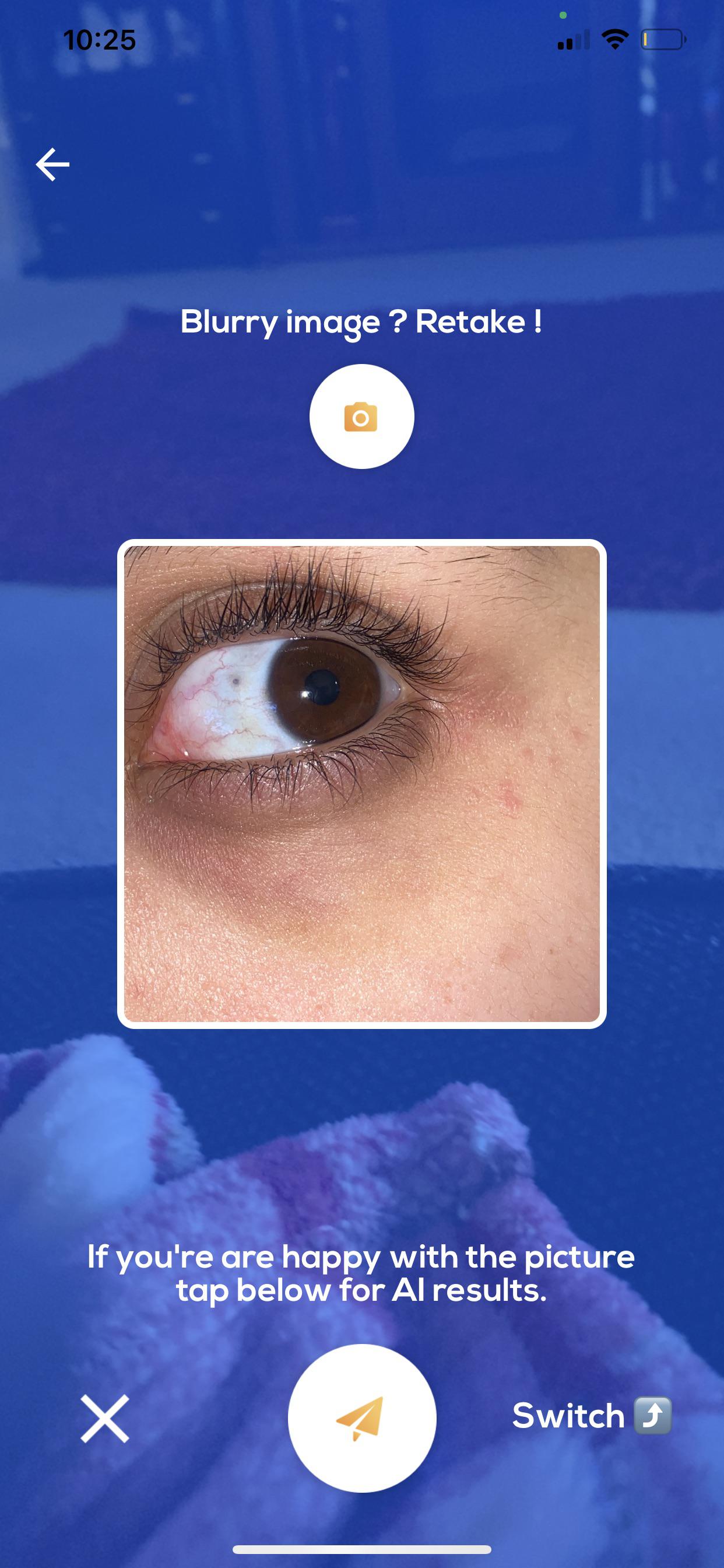 Had this little gray dot on my eye for as long as I can remember seen an eye doc was told it