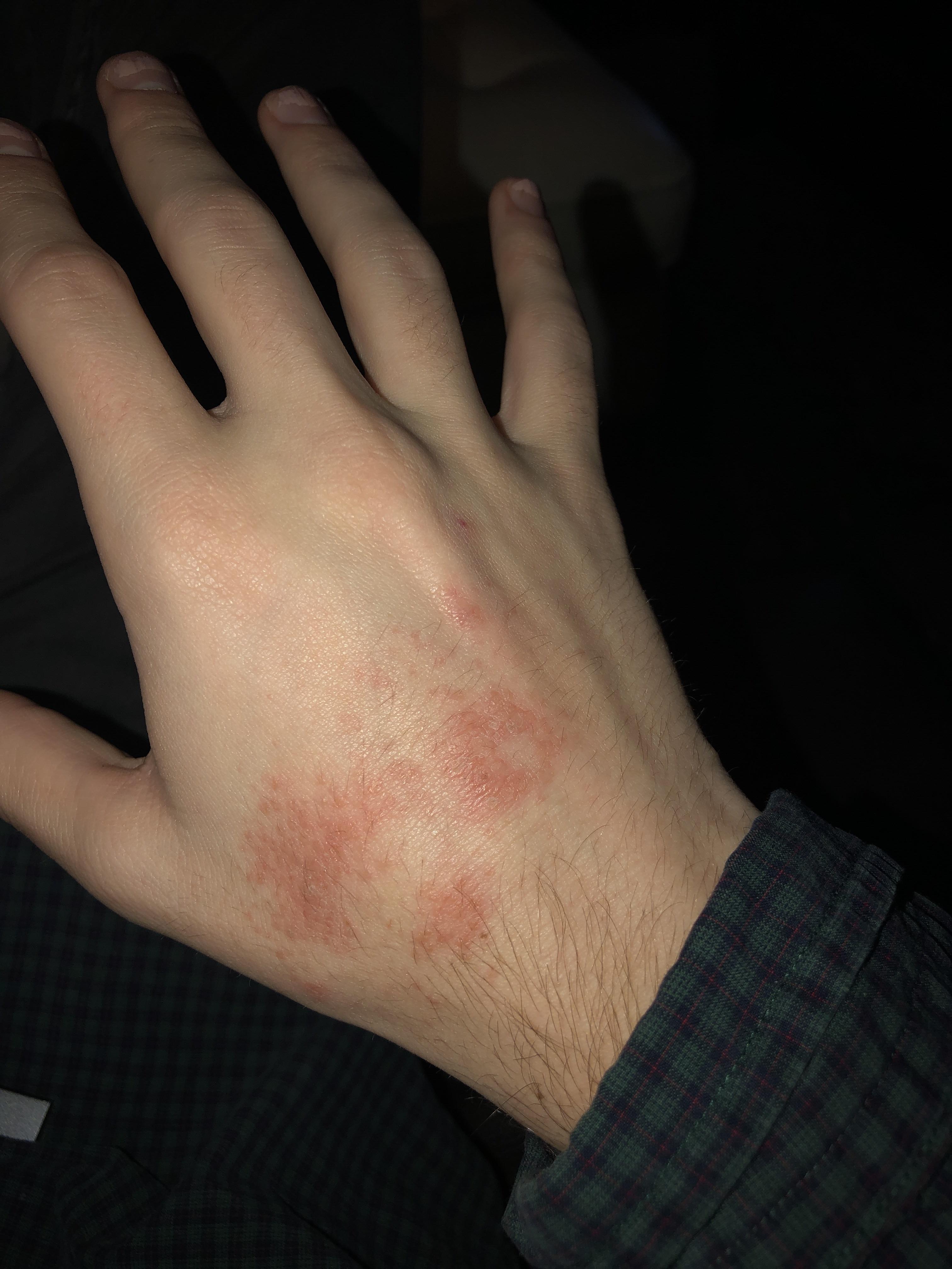 is eczema a side effect of accutane??? also is this eczema? r/Accutane