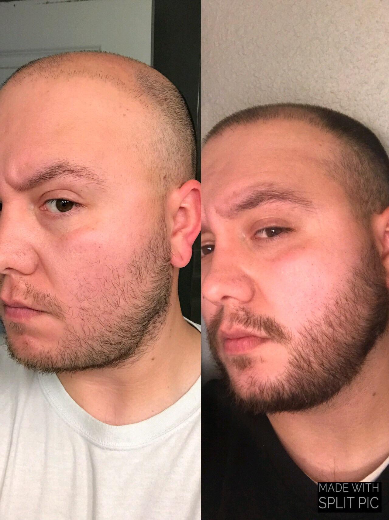4 month update, 30yrs old. Finasteride 1mg/day and Minoxidil 5 liquid