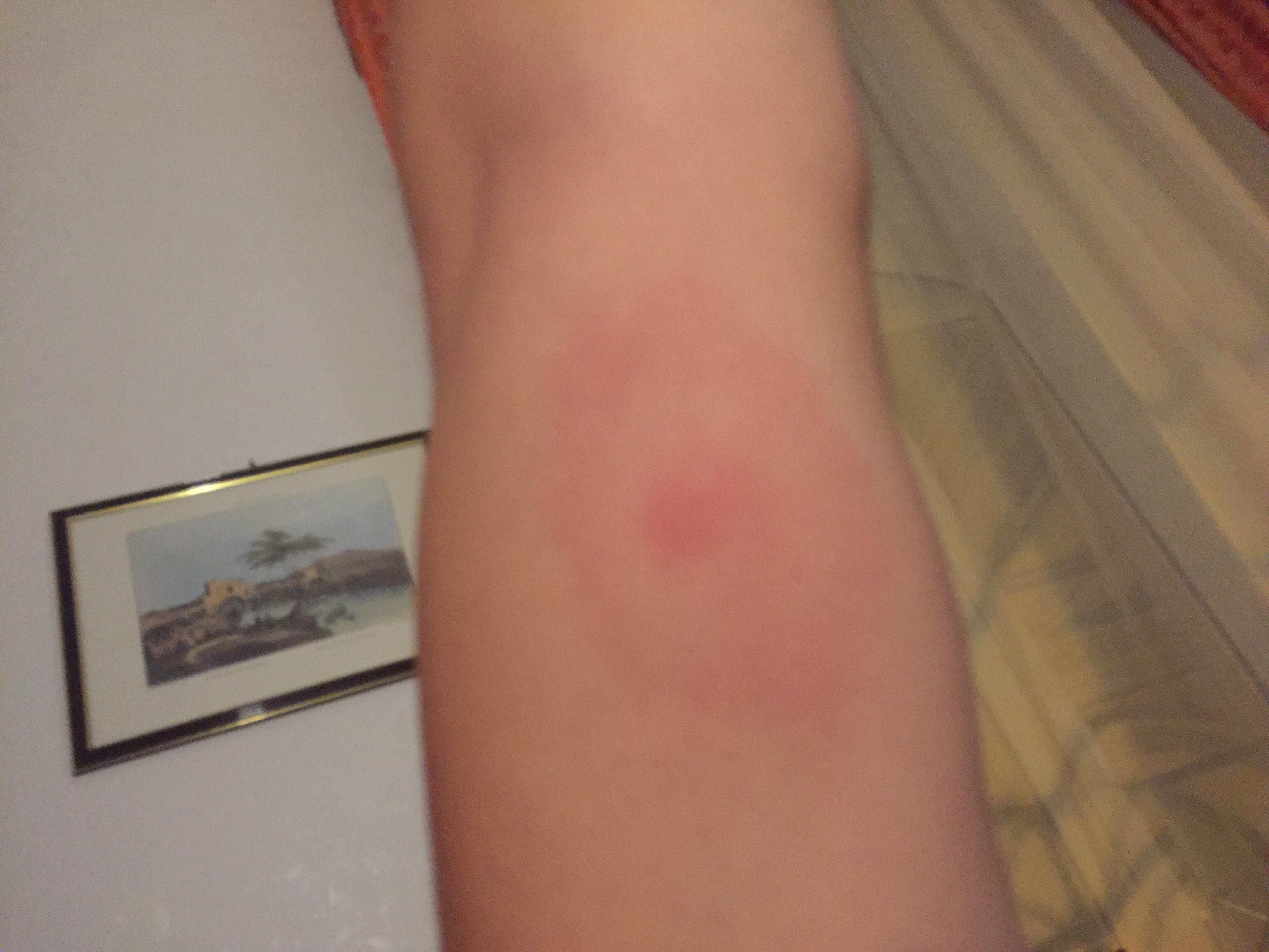 Not all bull’s-eye rashes are Lyme Disease Dr. Travis Elliott