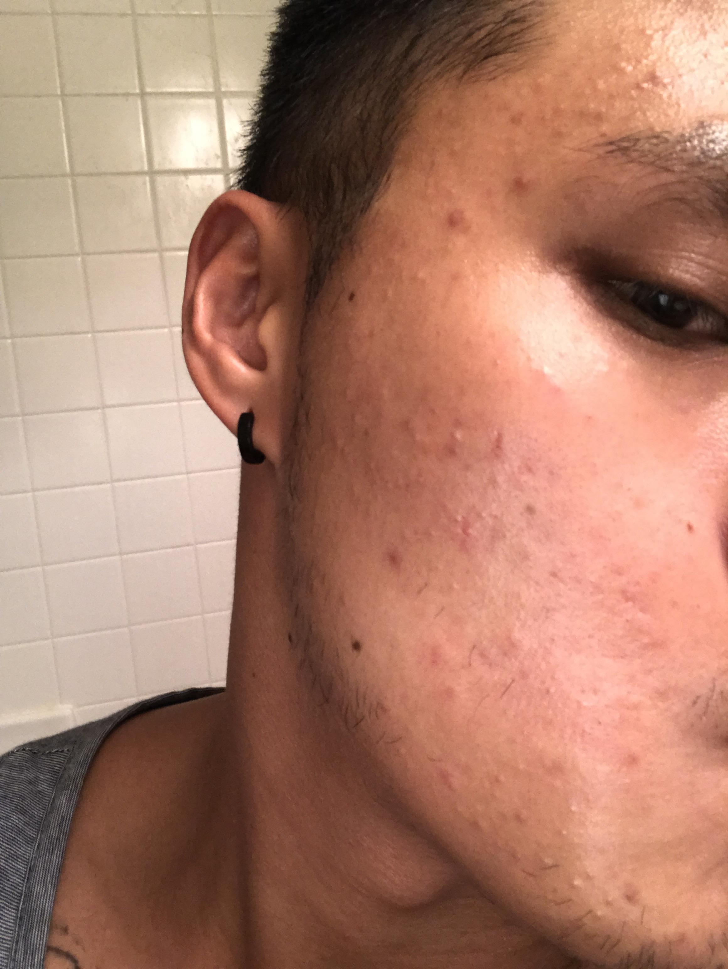 [Skin Concern] I can’t tell if it’s purging or it’s clogged pores or