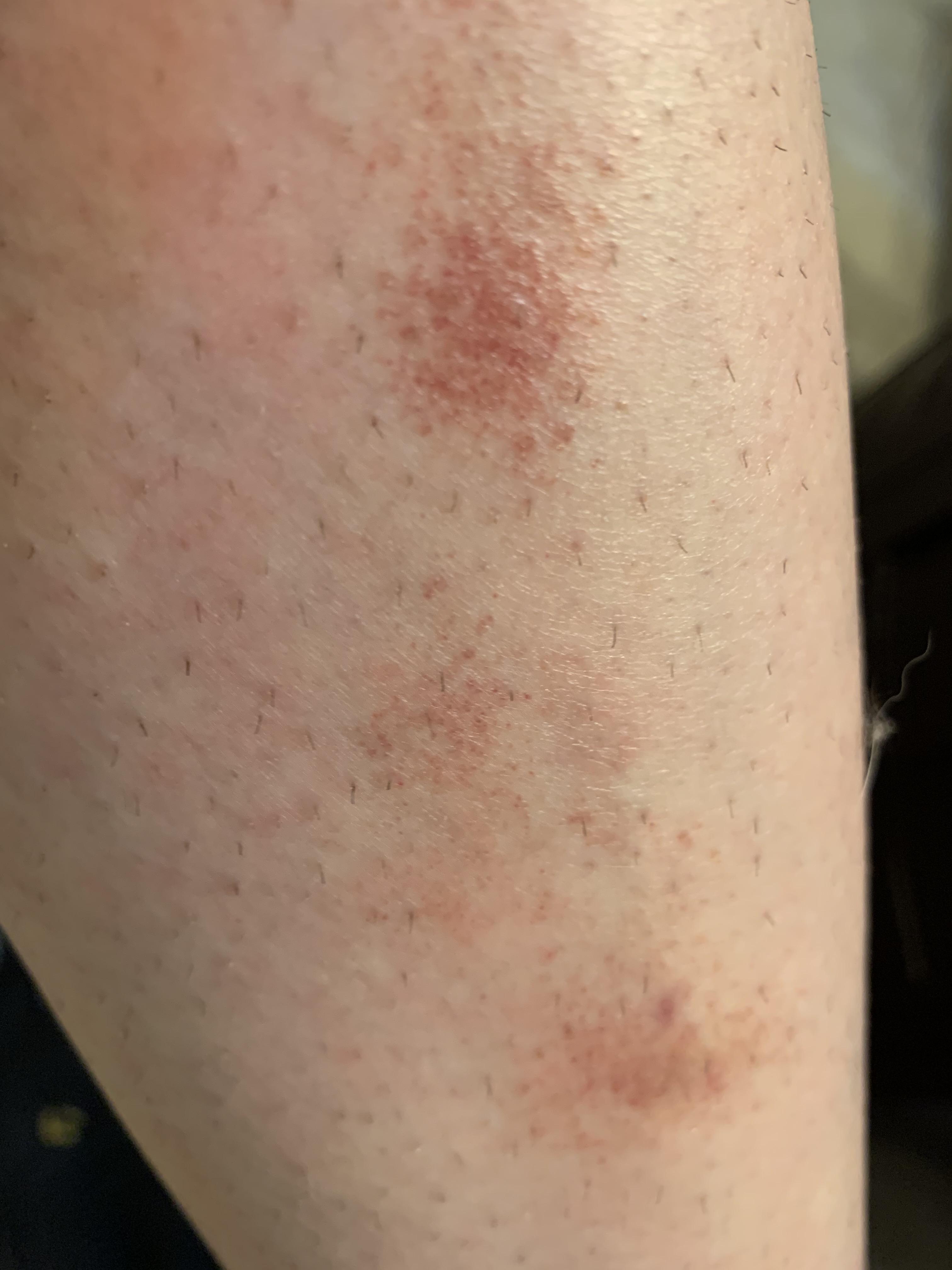 Has anyone ever had a rash like this related to Crohn’s? r/CrohnsDisease
