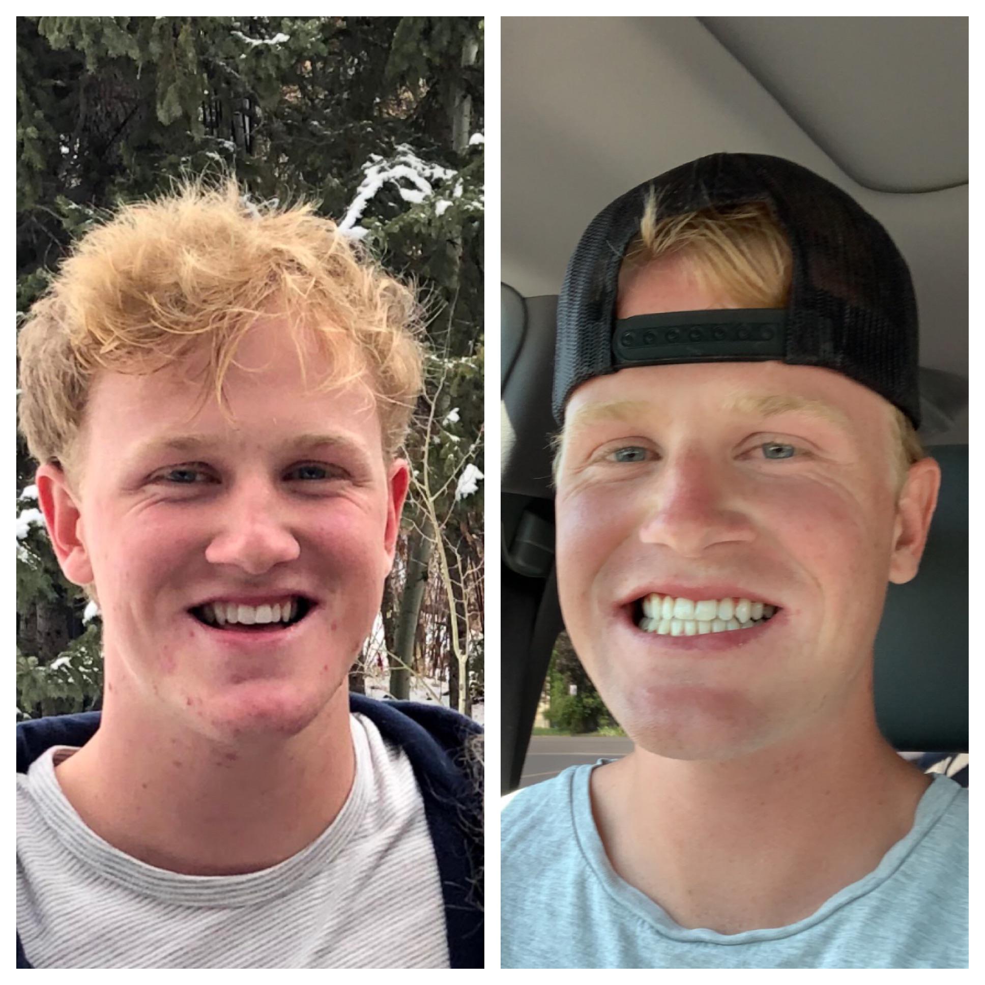 Before & After 26 months apart. Braces and double jaw surgery later
