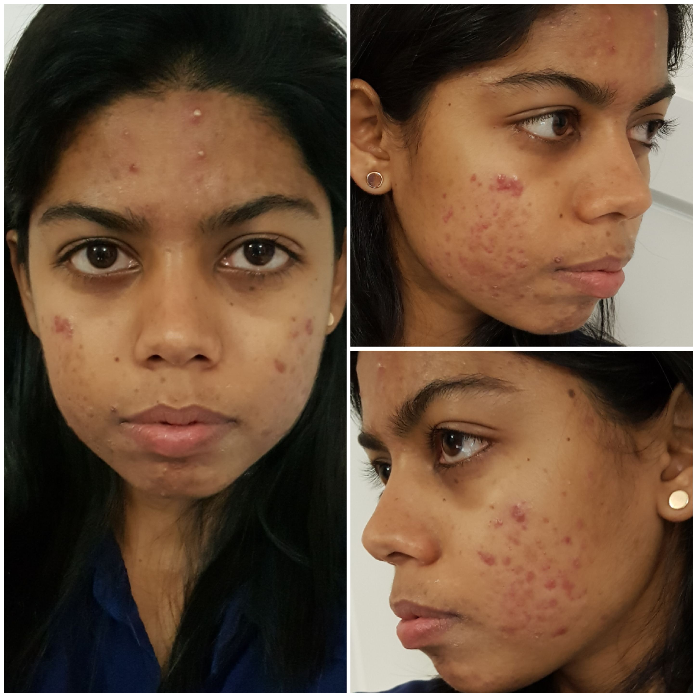 Accutane pain in legs