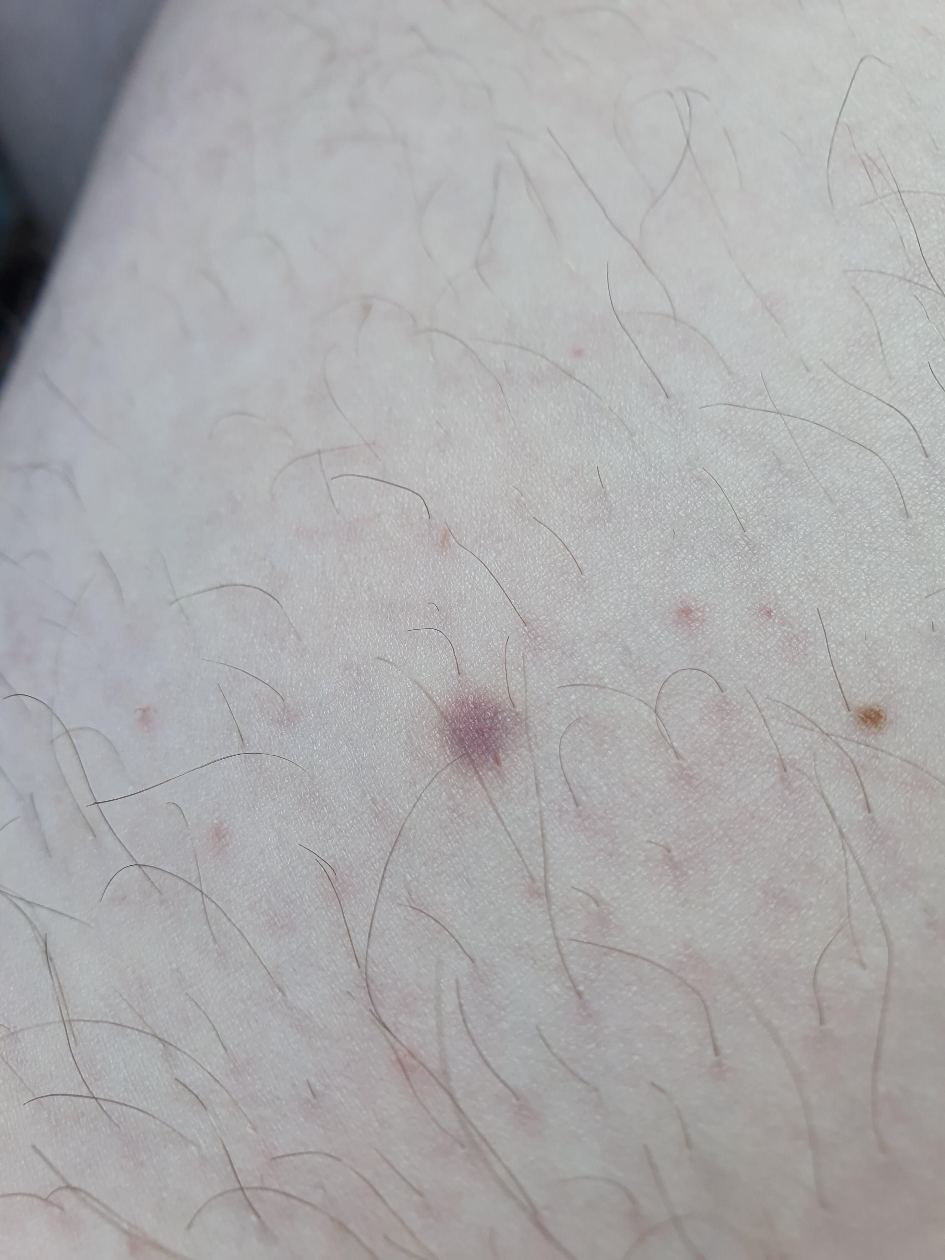 This random purple mark has appeared on my inner thigh overnight, the
