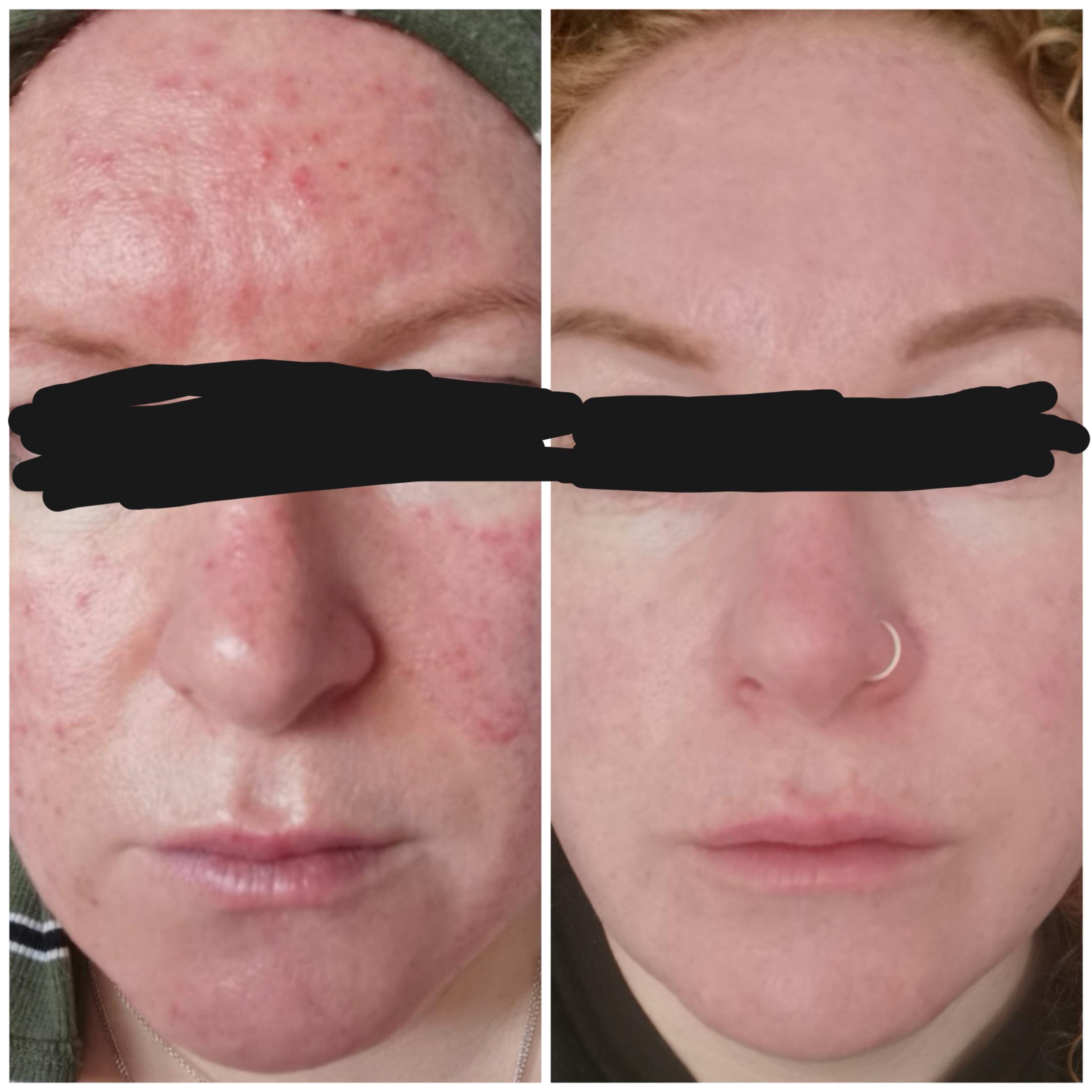Progress pic, approx six weeks into Rozex (Metronidazole) r/Rosacea
