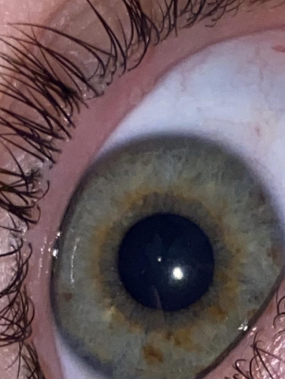just found these two bumps on my upper eyelid, anyone know what they