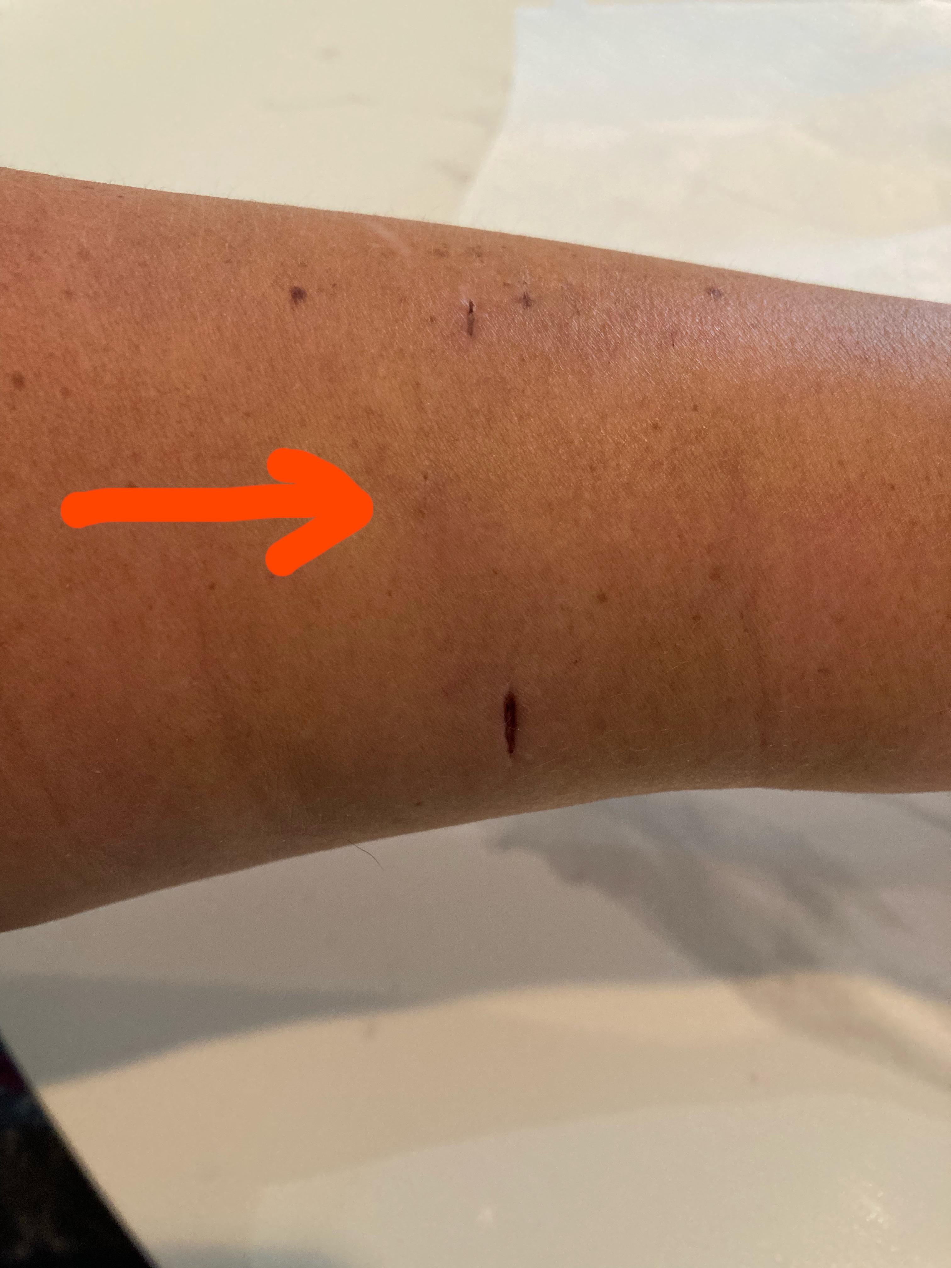 Concern about numbness near dog bite wound r/medical_advice