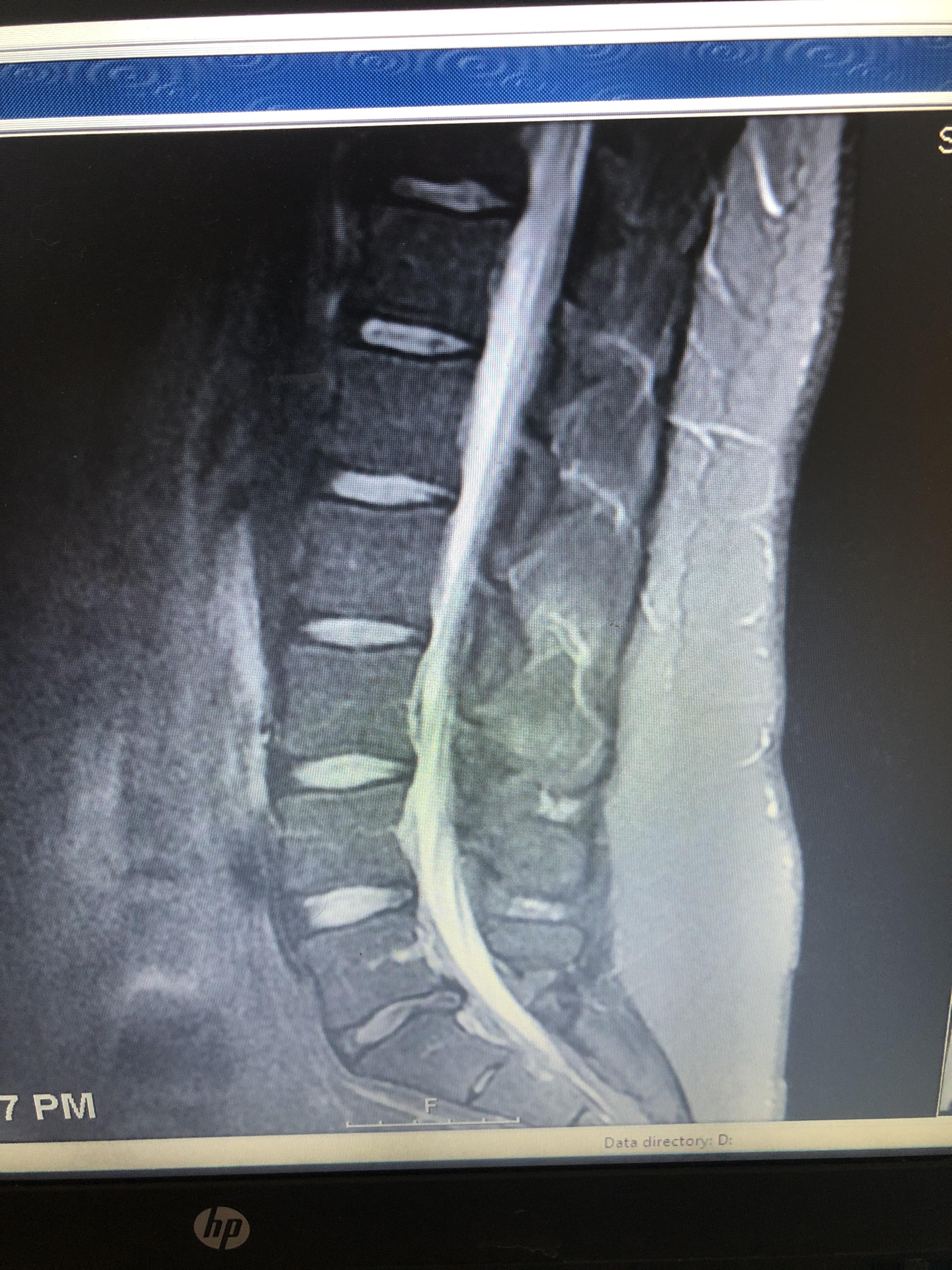 My L5/S1 herniated disc due to degenerative disc disease. r/Sciatica