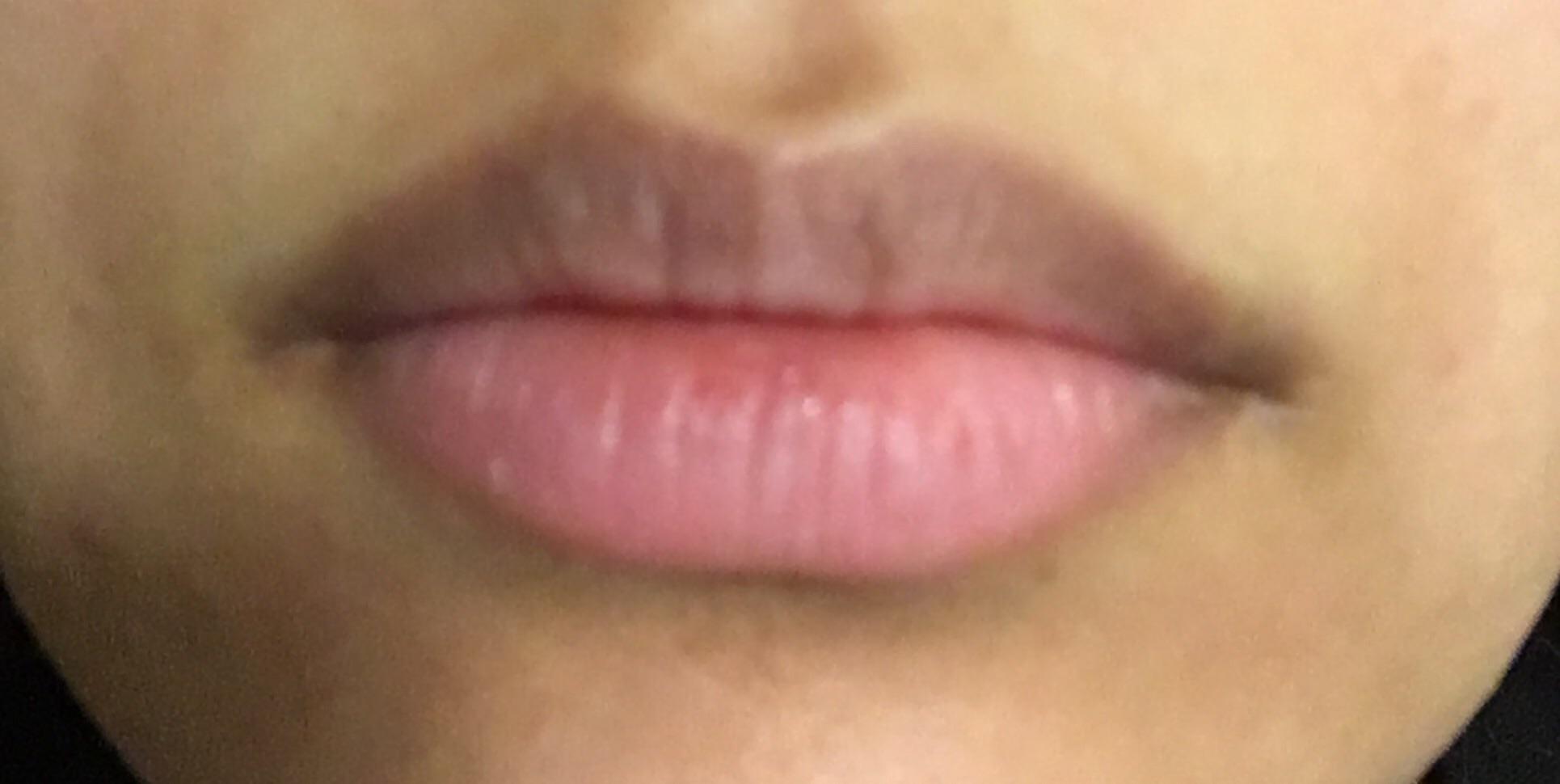 [Skin Concerns] Help My lips have deep lines that won't go away r