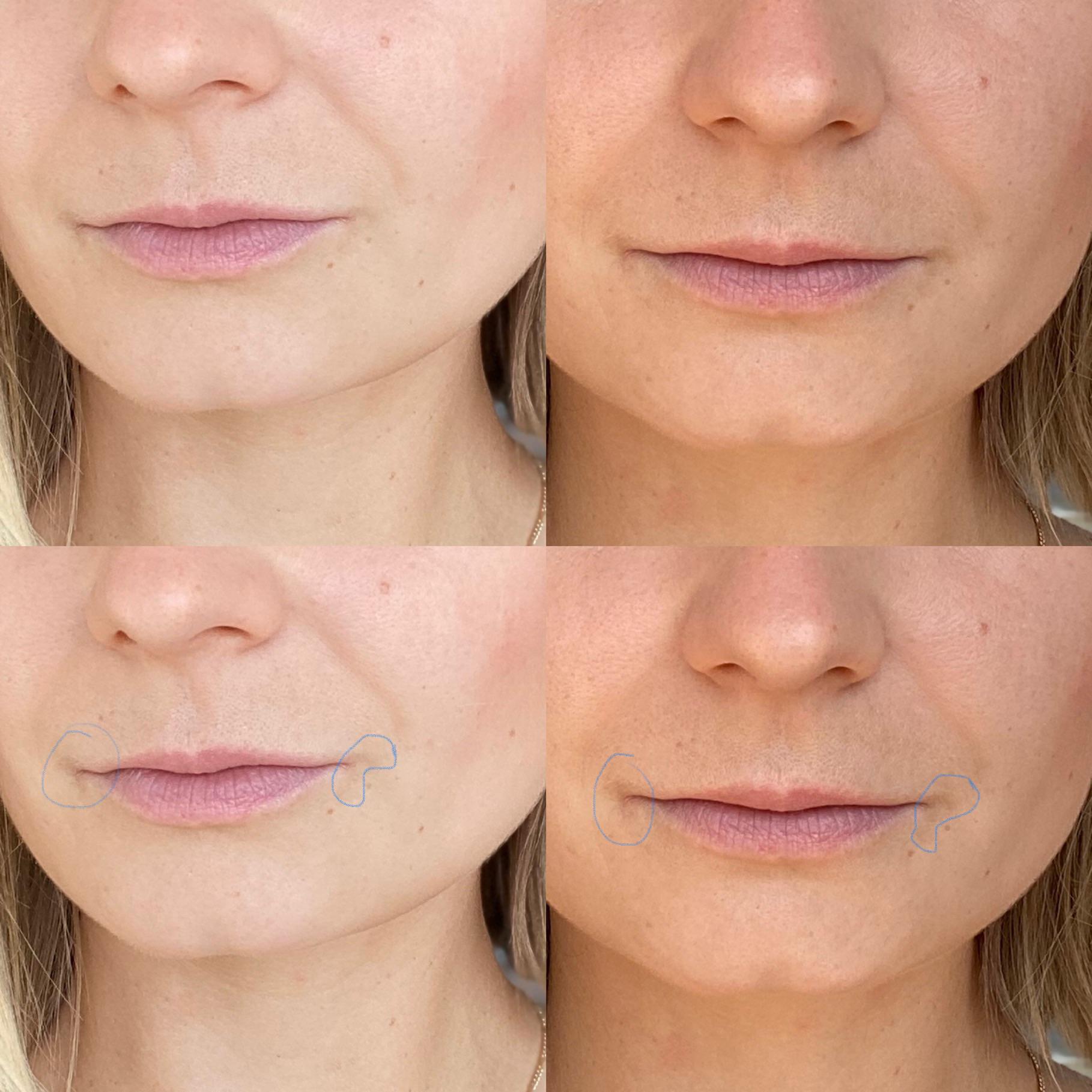 Weird discoloration in corners of the mouth advice? r/SkincareAdvice