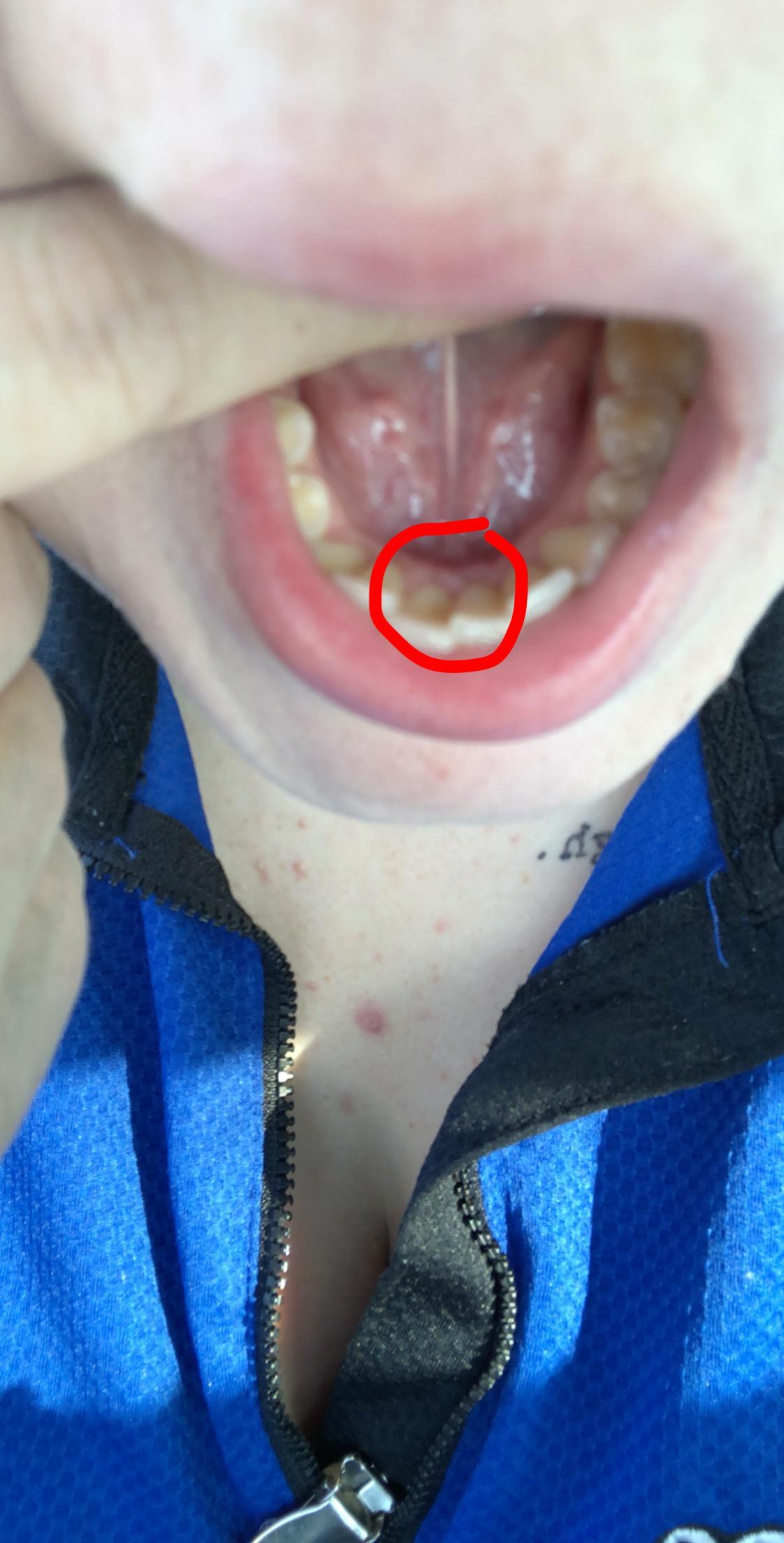 Considering retiring my tongue piercing after less than a year, since