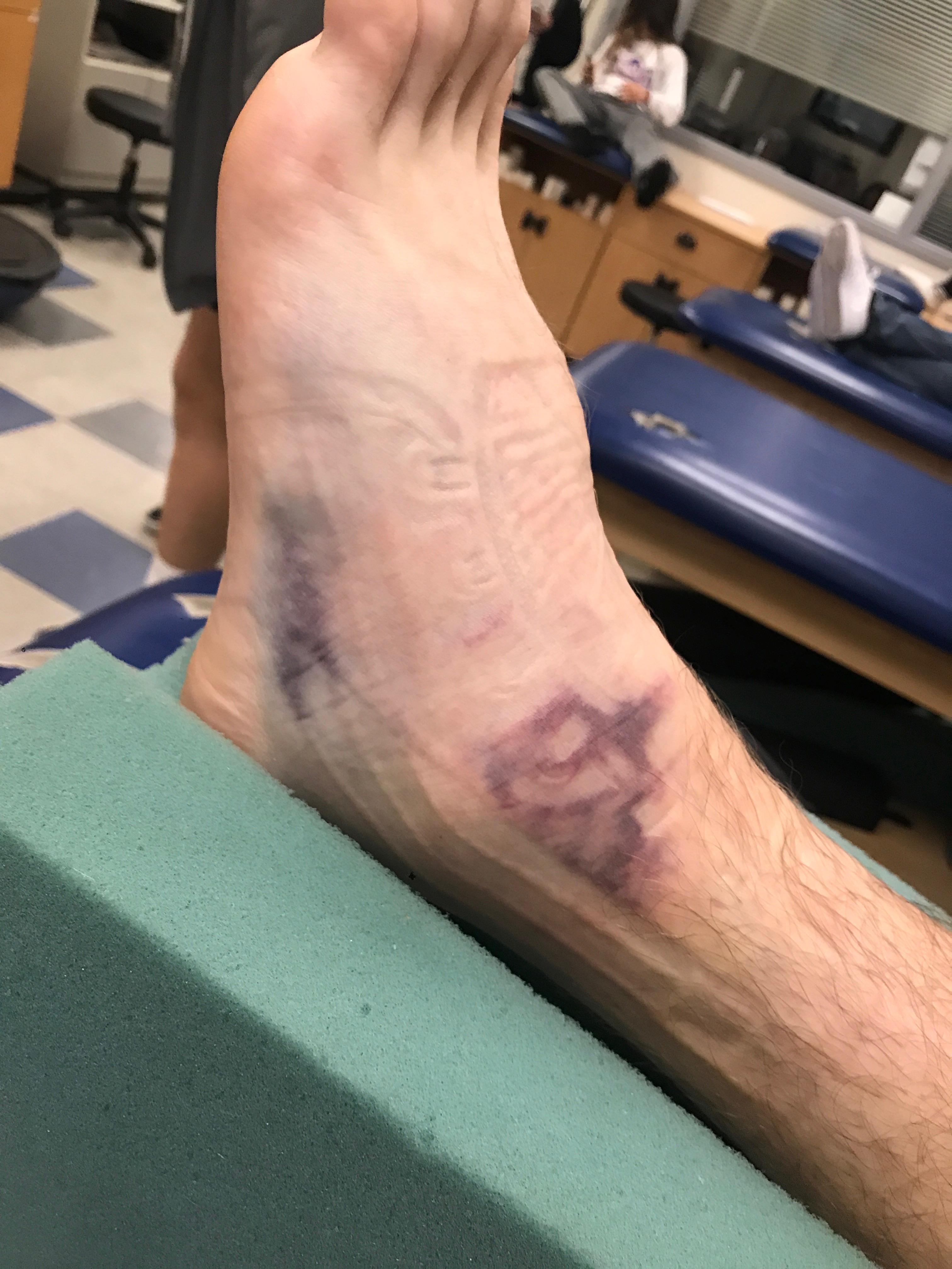 I hurt my ankle about 10 months ago. My trainers at my school said it