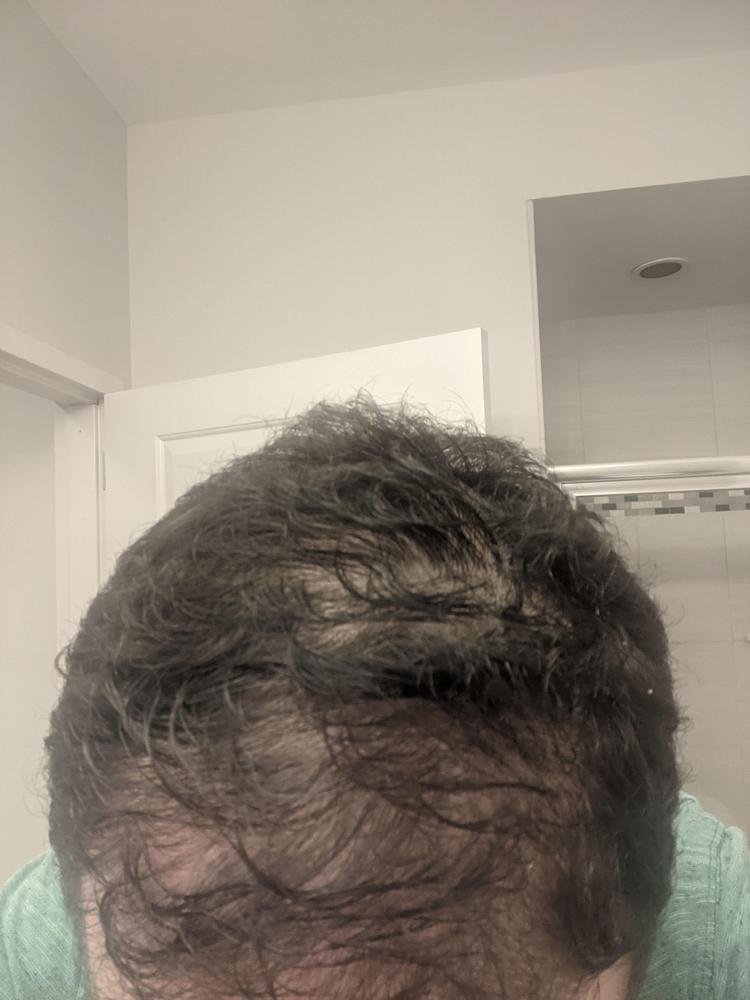 Is it too late to reverse this hair loss? It's falling out and thinning