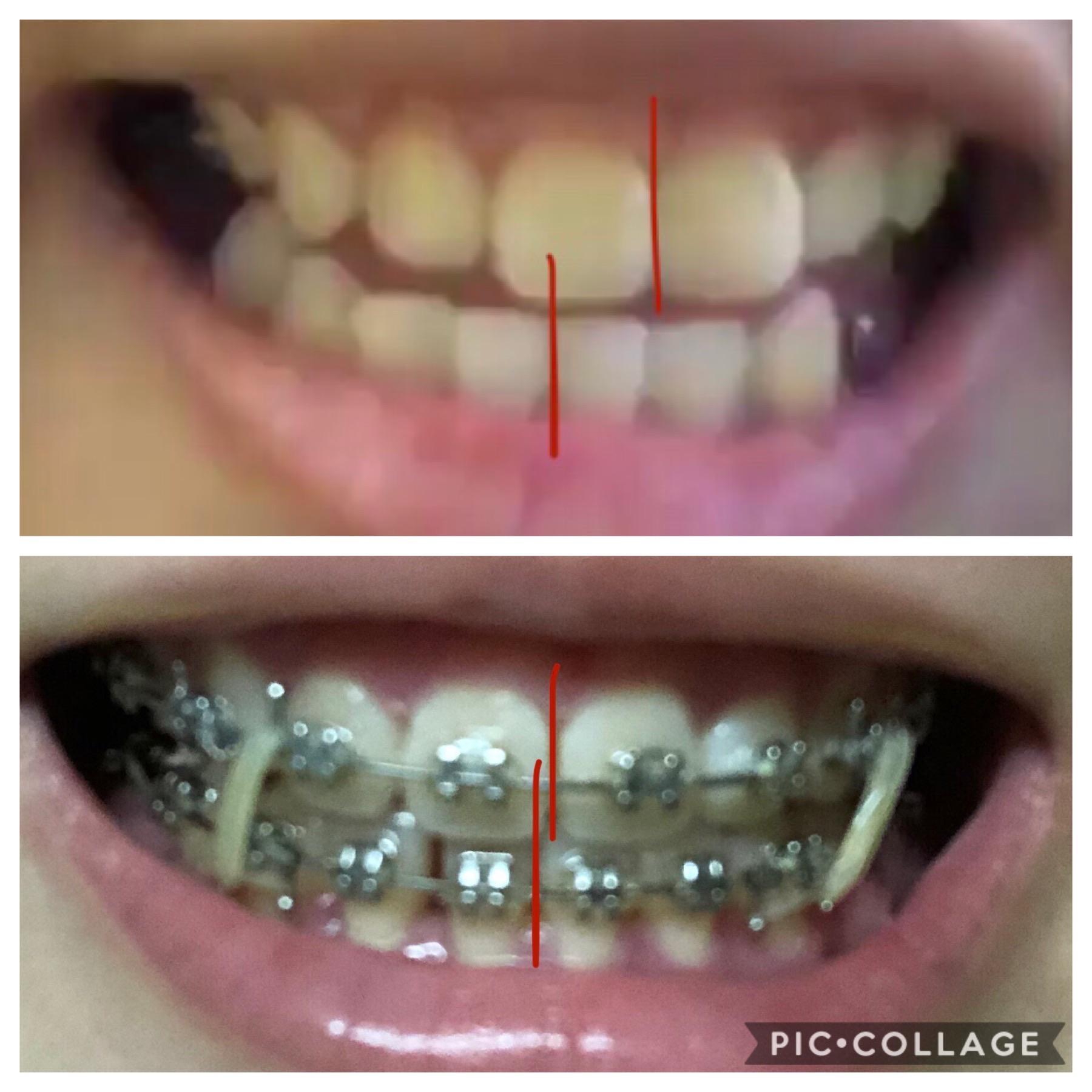 I’ve had braces since Oct 2018 (mainly to shift my jawline) and I am so