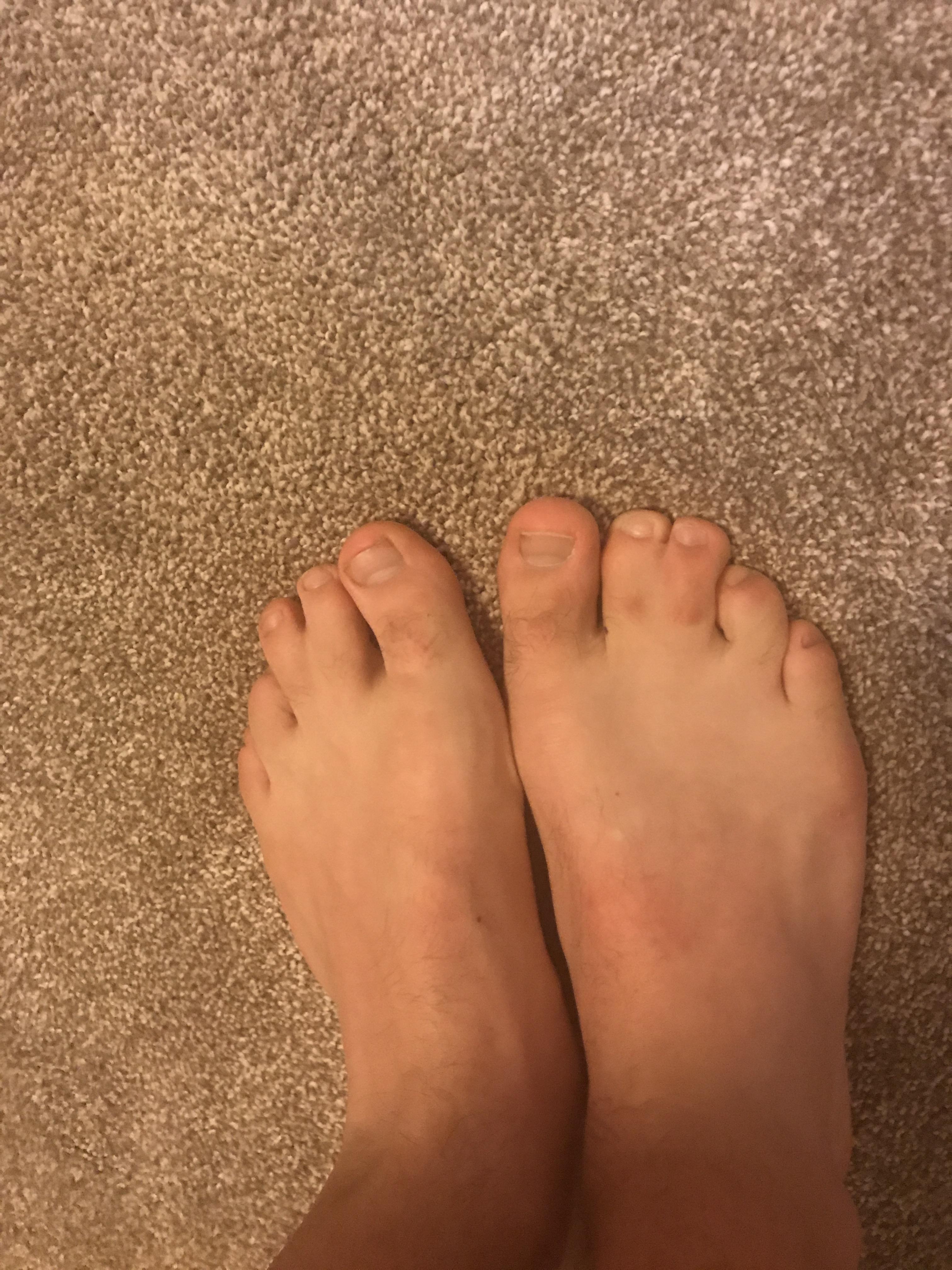 I was born with syndactyly, which basically fused two of my toes