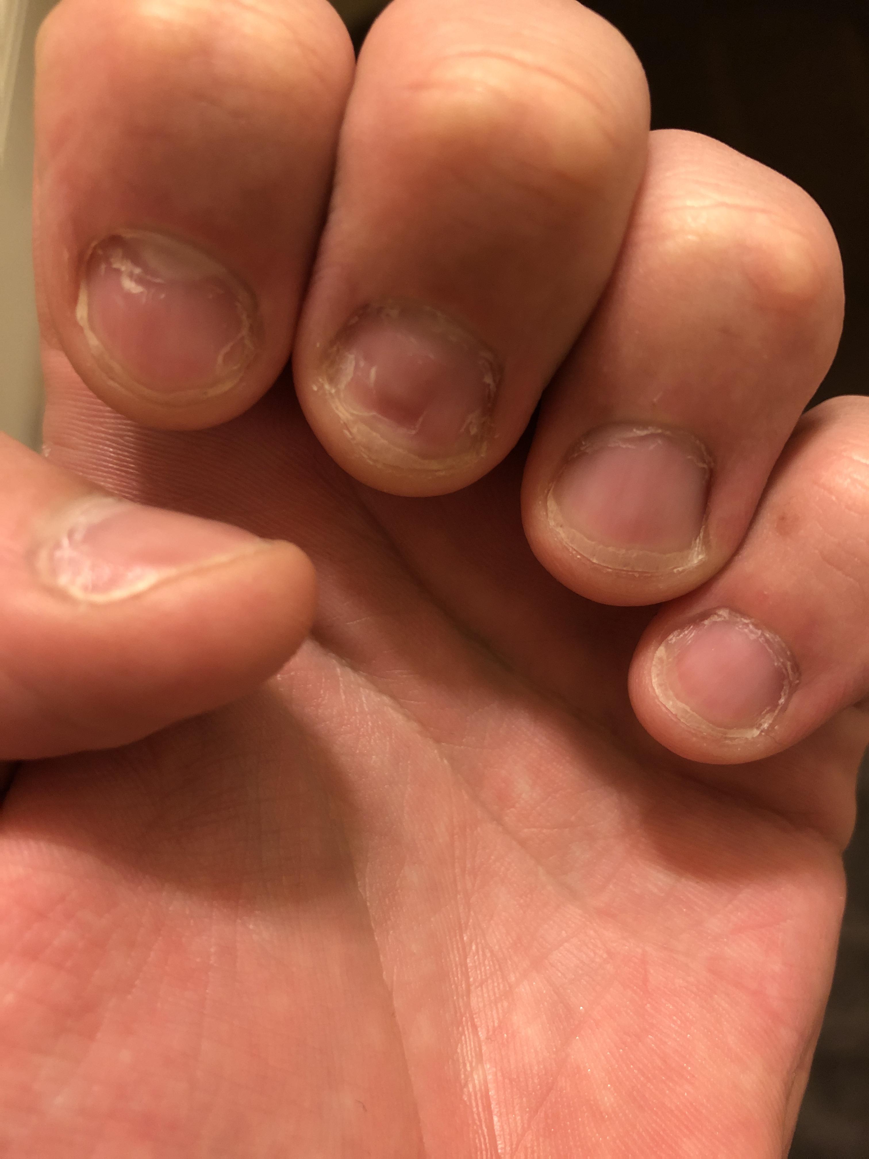 Will my nail beds grow out? r/nailbiting
