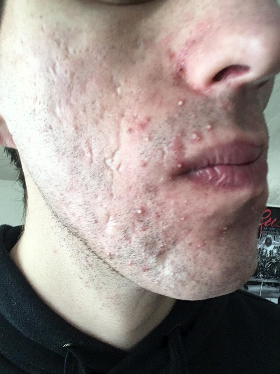 [Acne] Need help with finding cause of whiteheads/pastules. Post in
