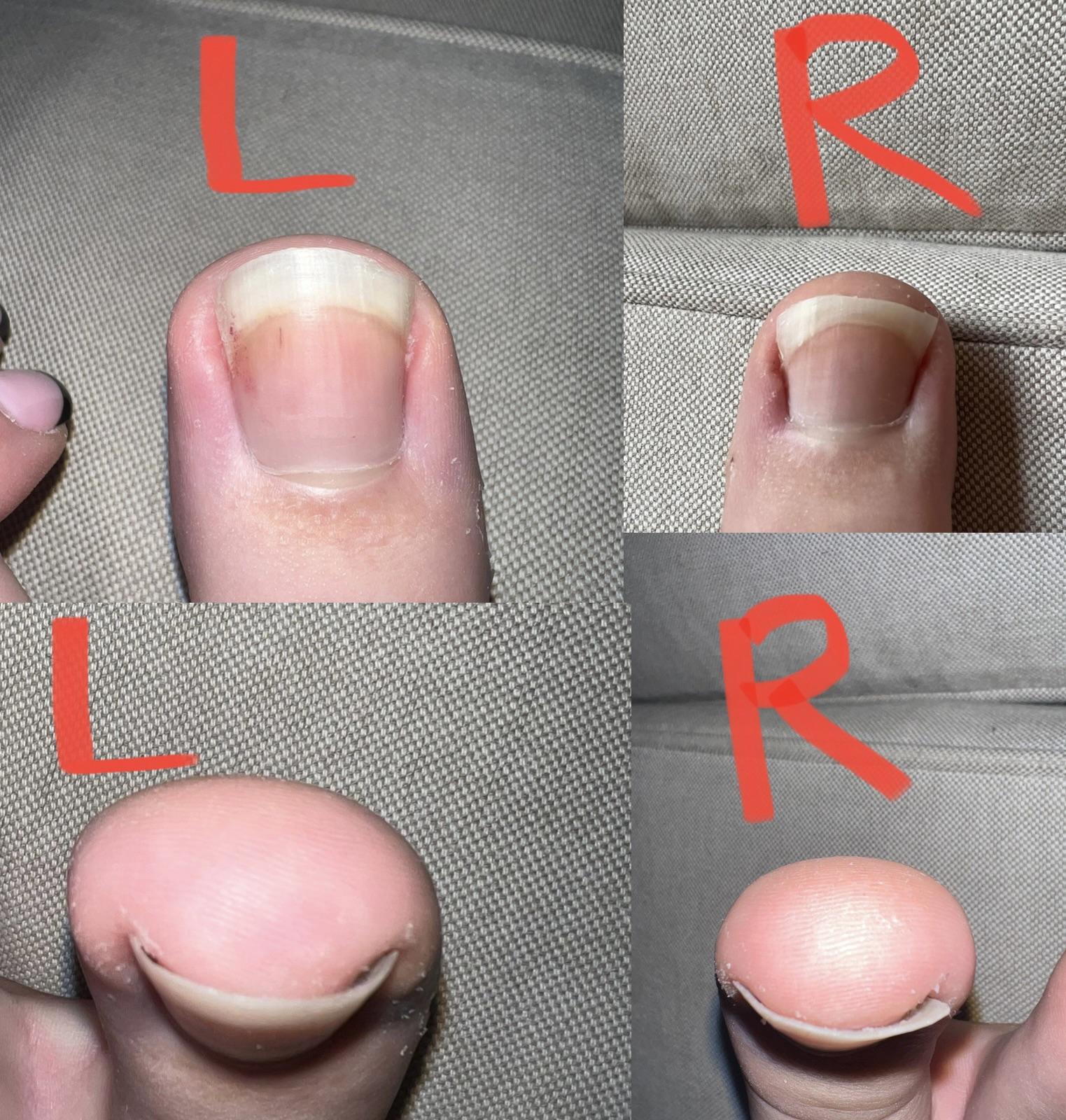 Are my big toe nails ingrown? r/Ingrown_Toenails
