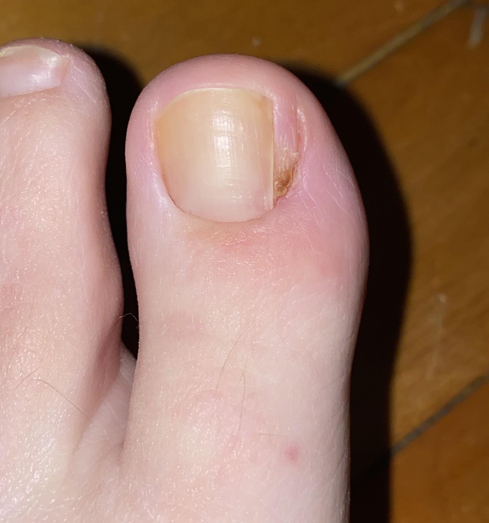 New pain almost 4 weeks after partial nail avulsion r/Ingrown_Toenails