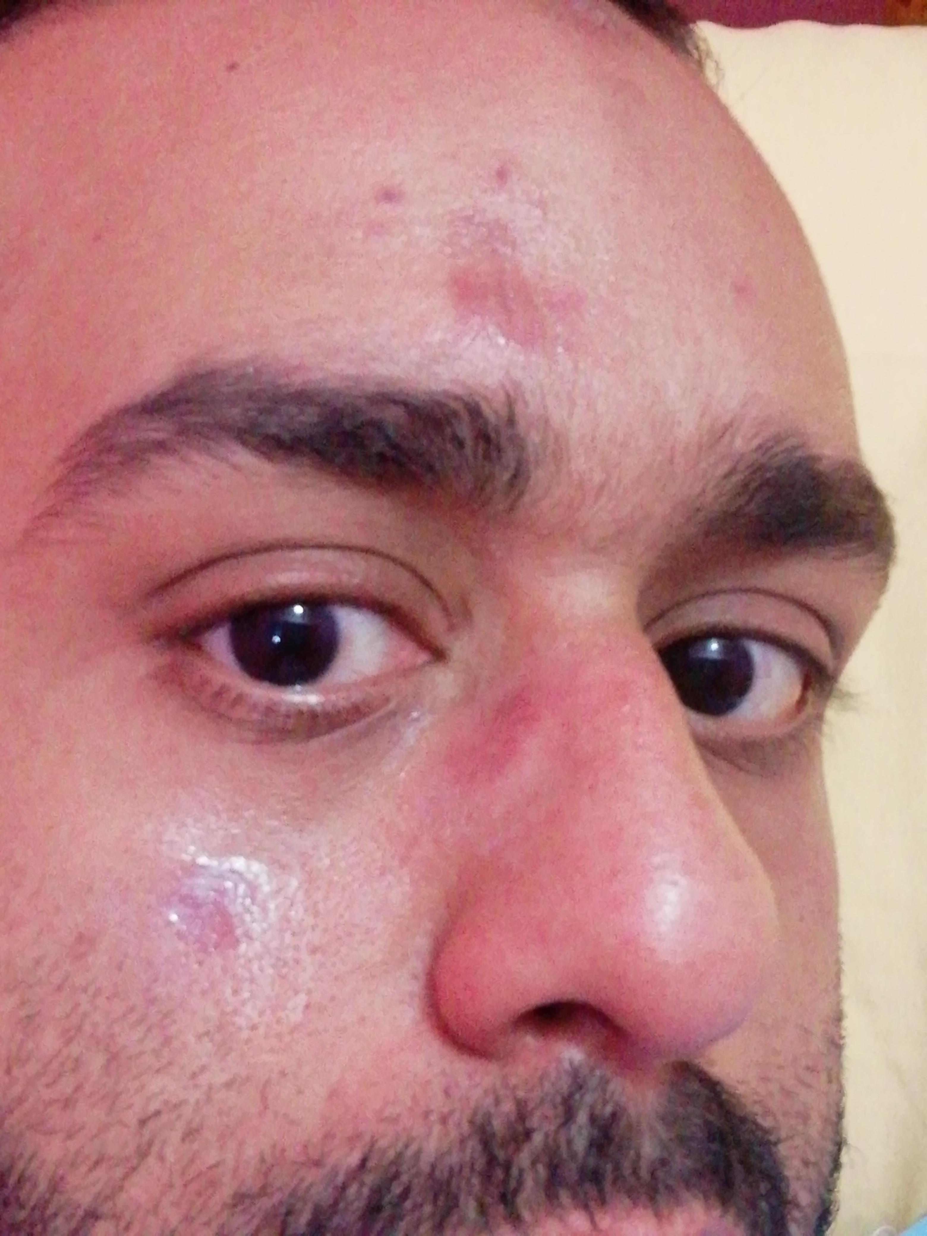 This is my face day 20 post co2 laser resurfacing... Still dark redness