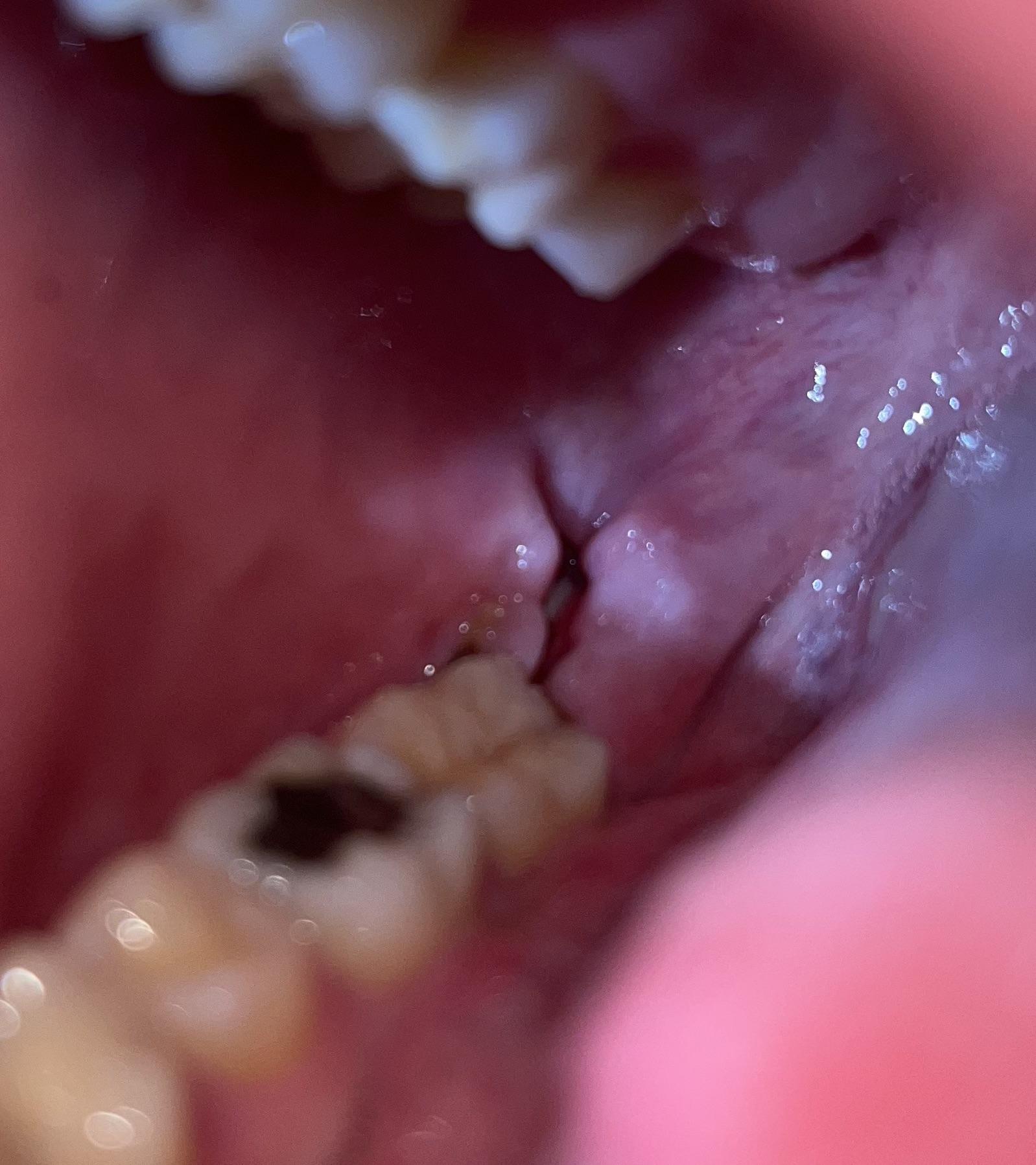 Did my stitches fall out? Should I be concerned?? r/wisdomteeth