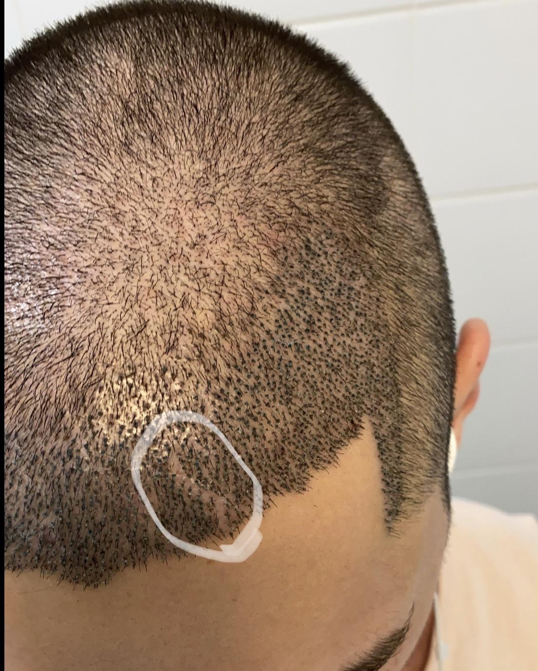 5 days after fue transplant and i noticed a bald gap that wasnt there