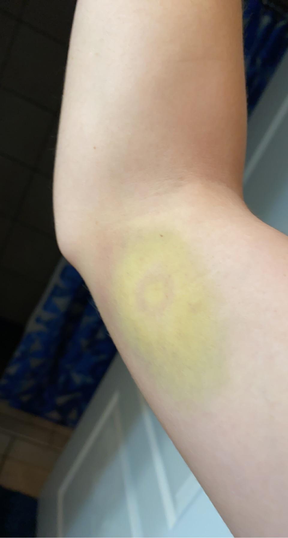 My bruise from paintball looks like an avocado r/mildlyinteresting