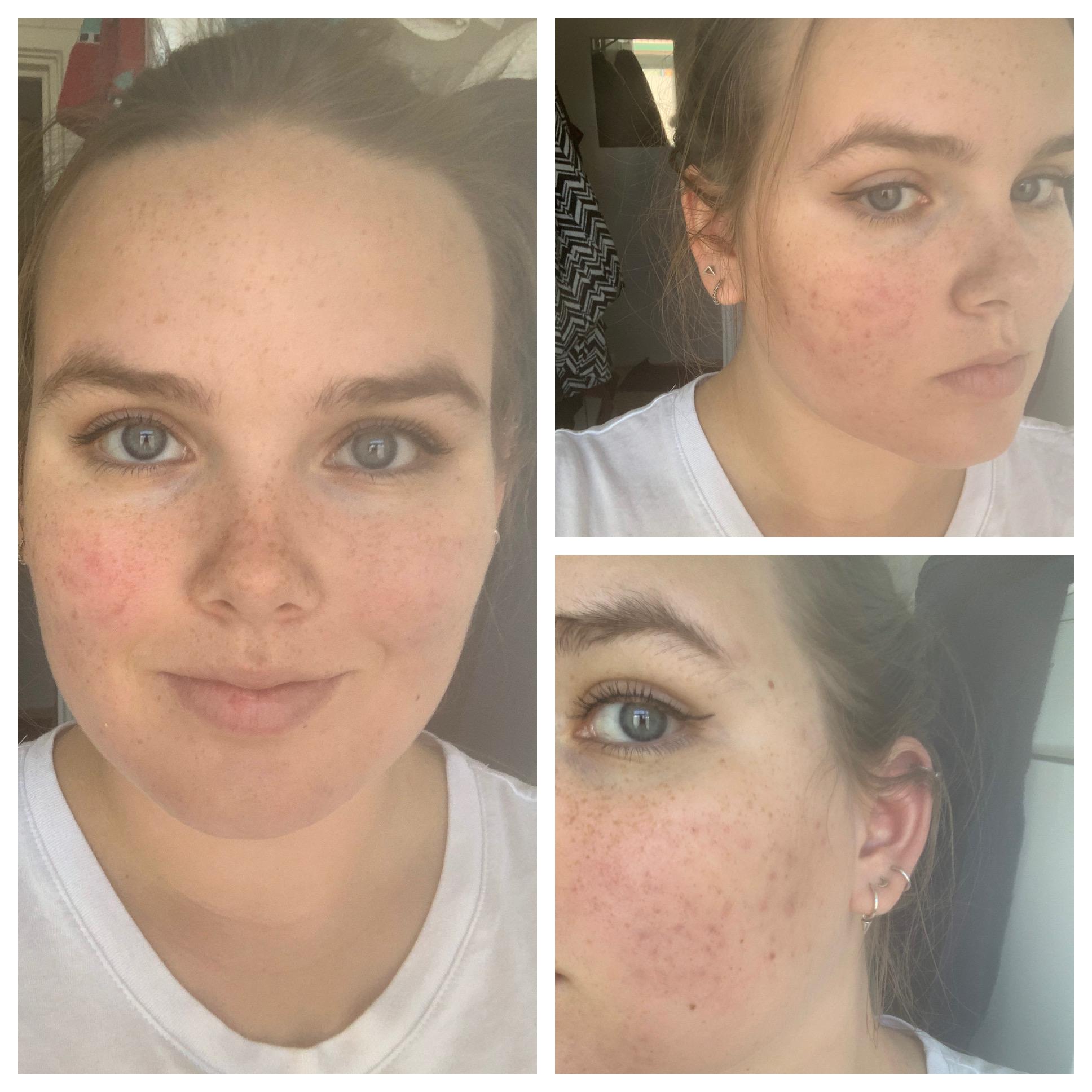 [Routine help] Acne is getting better. How do I achieve smooth skin