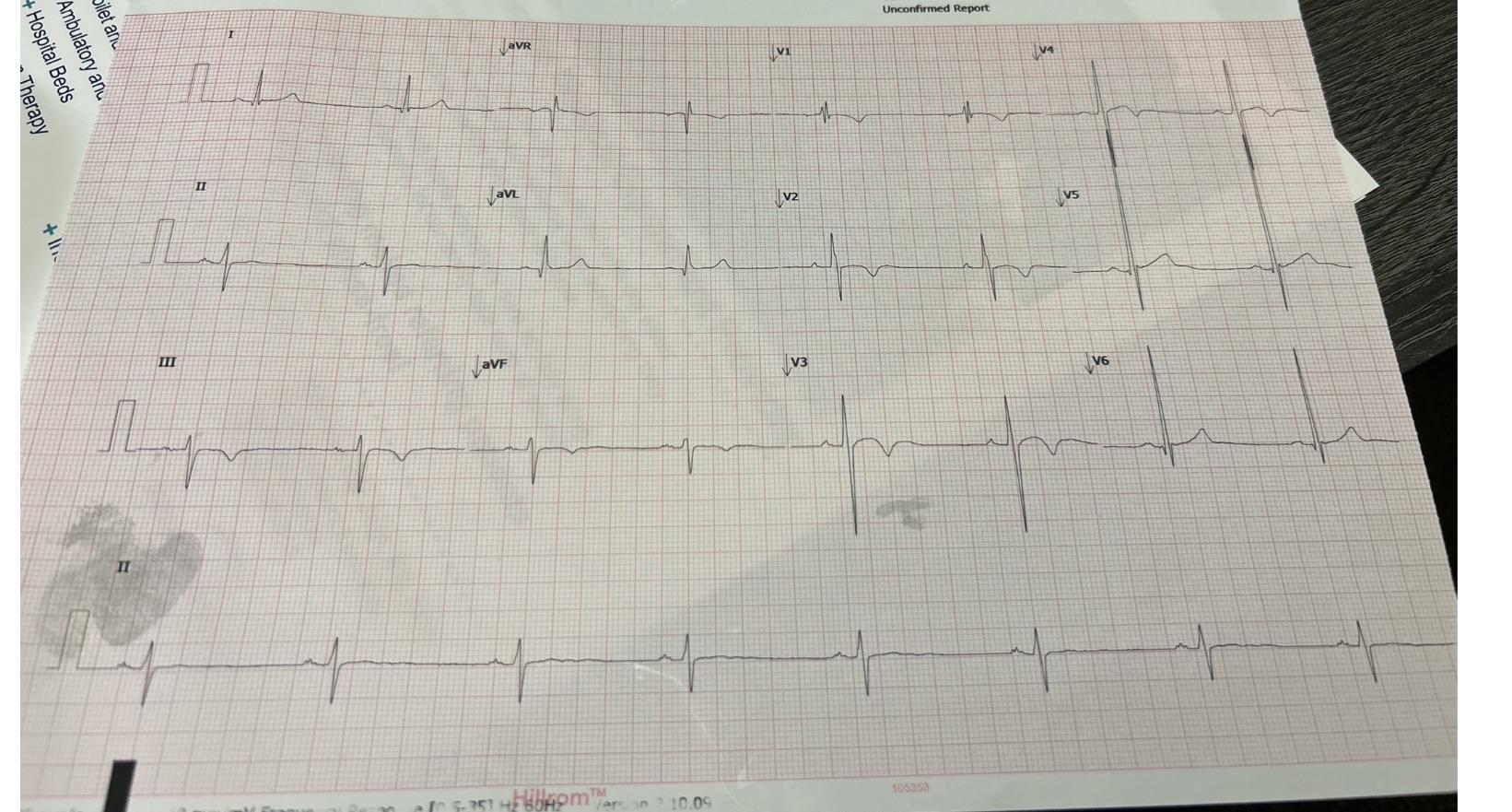 Been hung up on this EKG…sent this 57 y/o male w few week history of