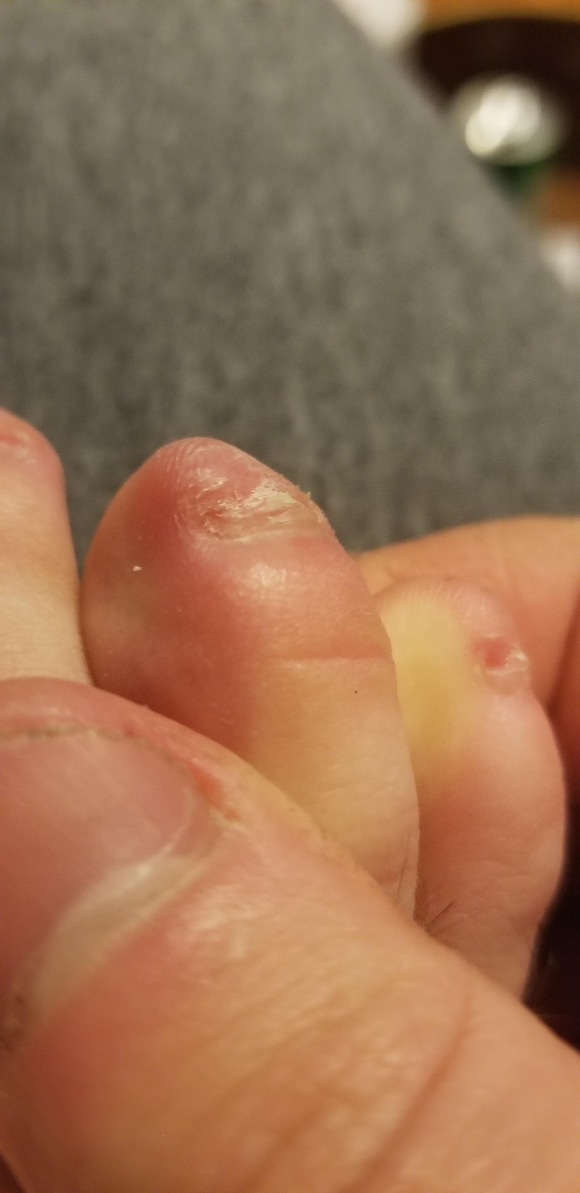 Painful redpurple lump on toe? r/medical_advice