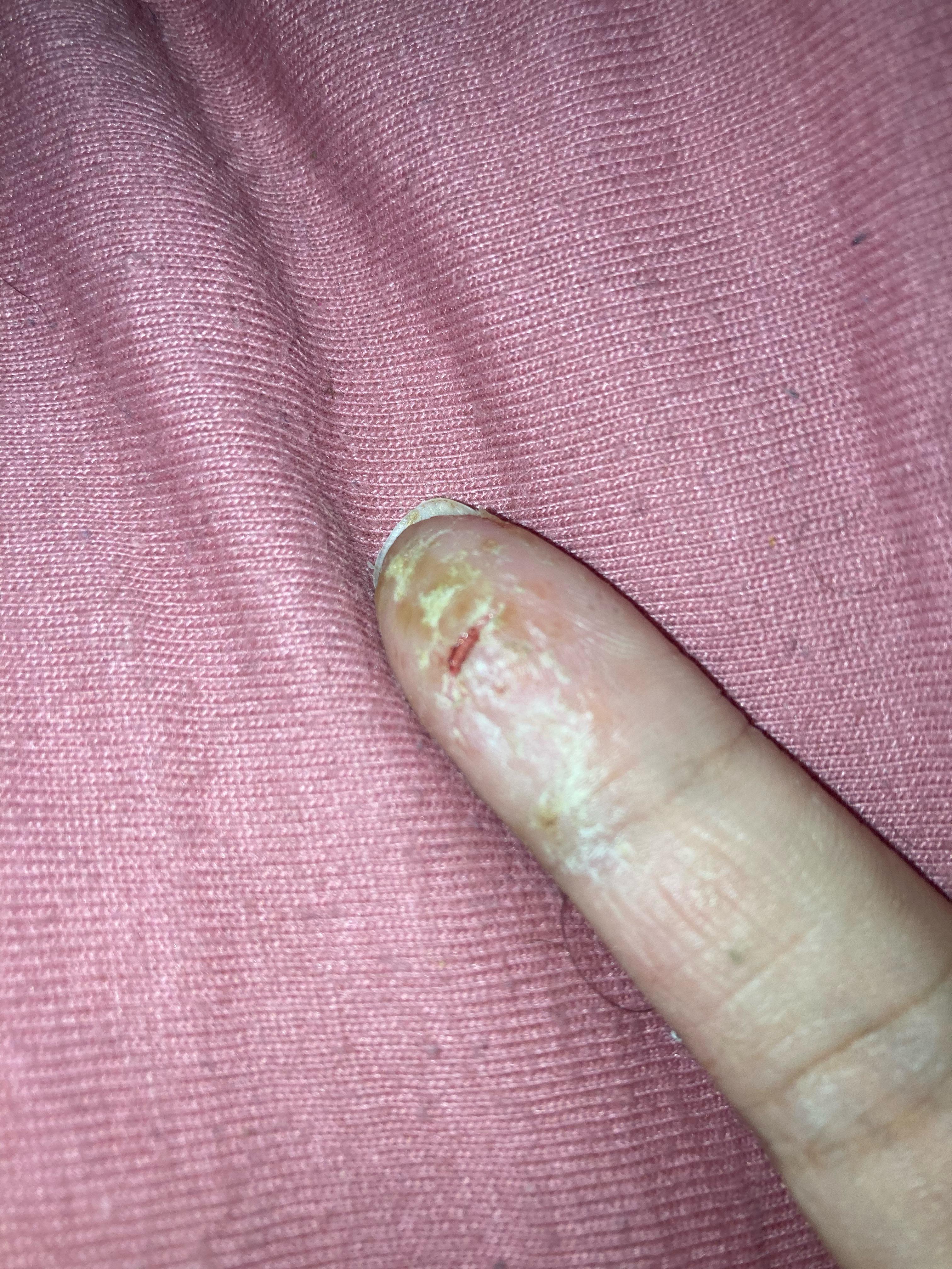 What should I do? It hurts really badly r/eczema