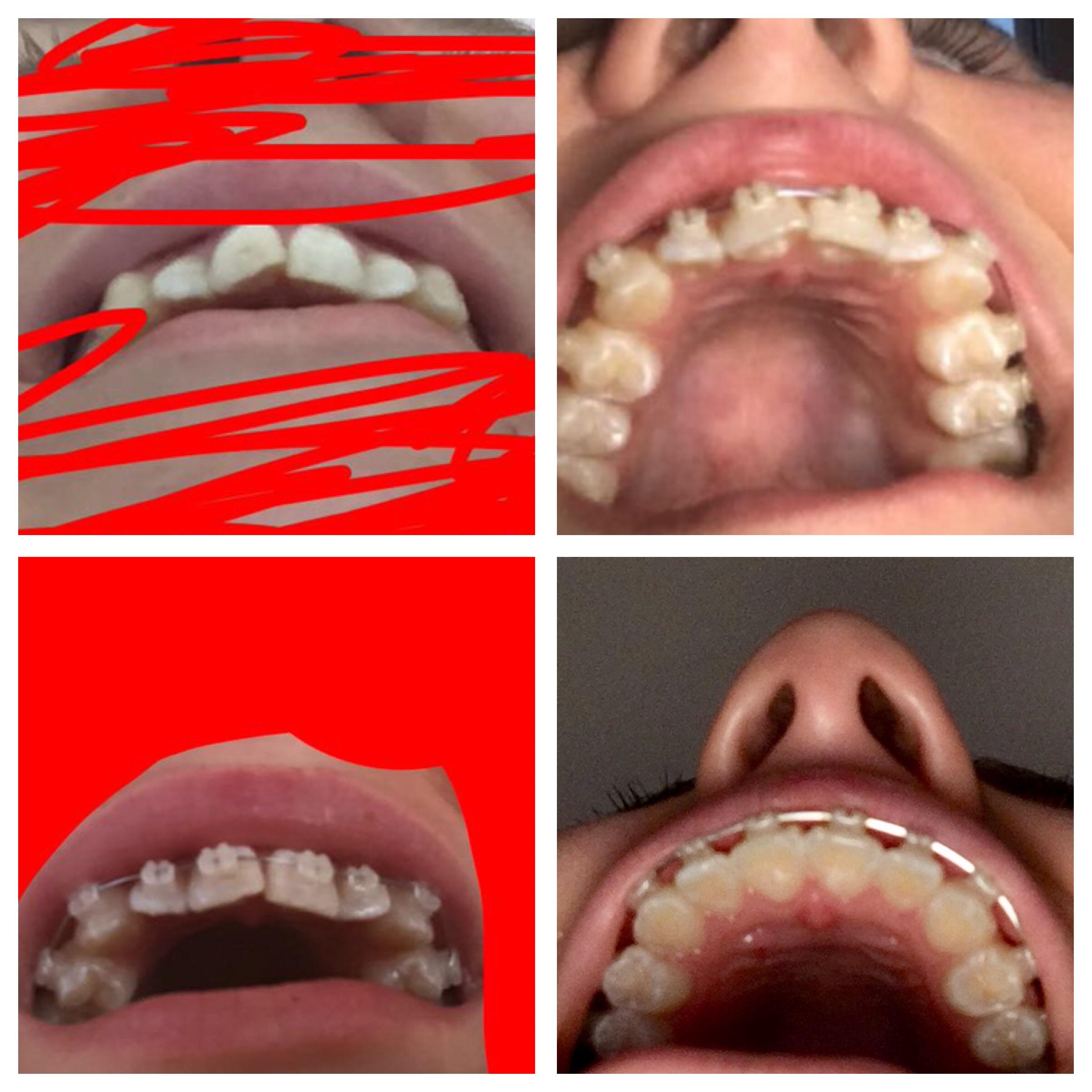 They’re coming off in March ) r/braces