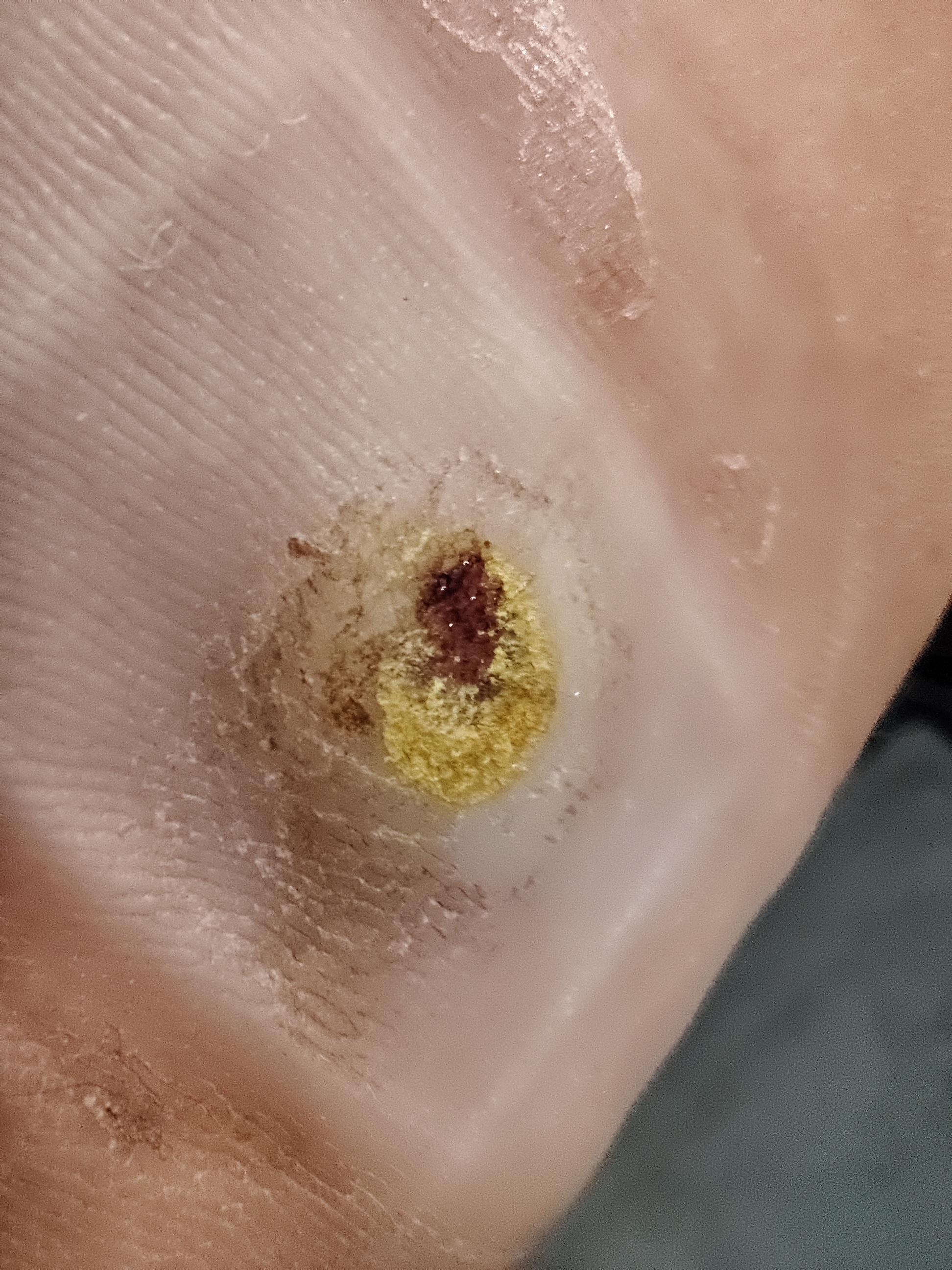 Plantar Wart Removal Cantharidin at Ann Richard blog
