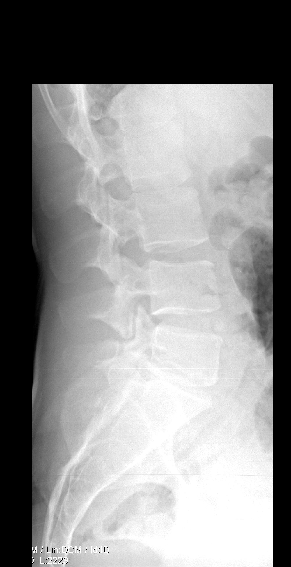31/M Lumbar Pain; Pelvic Pain; Left Arm and Leg numbness. Pelvic pain has gotten to the point