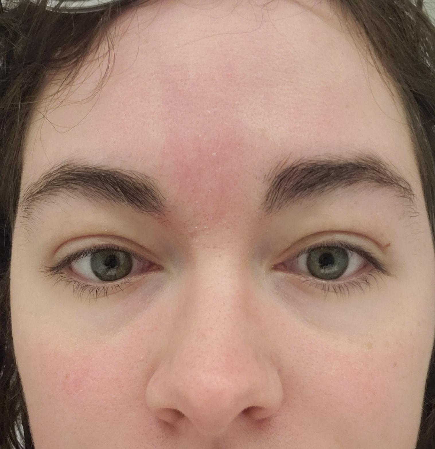 [Skin Concern] Help with redness on forehead and cheeks, also need