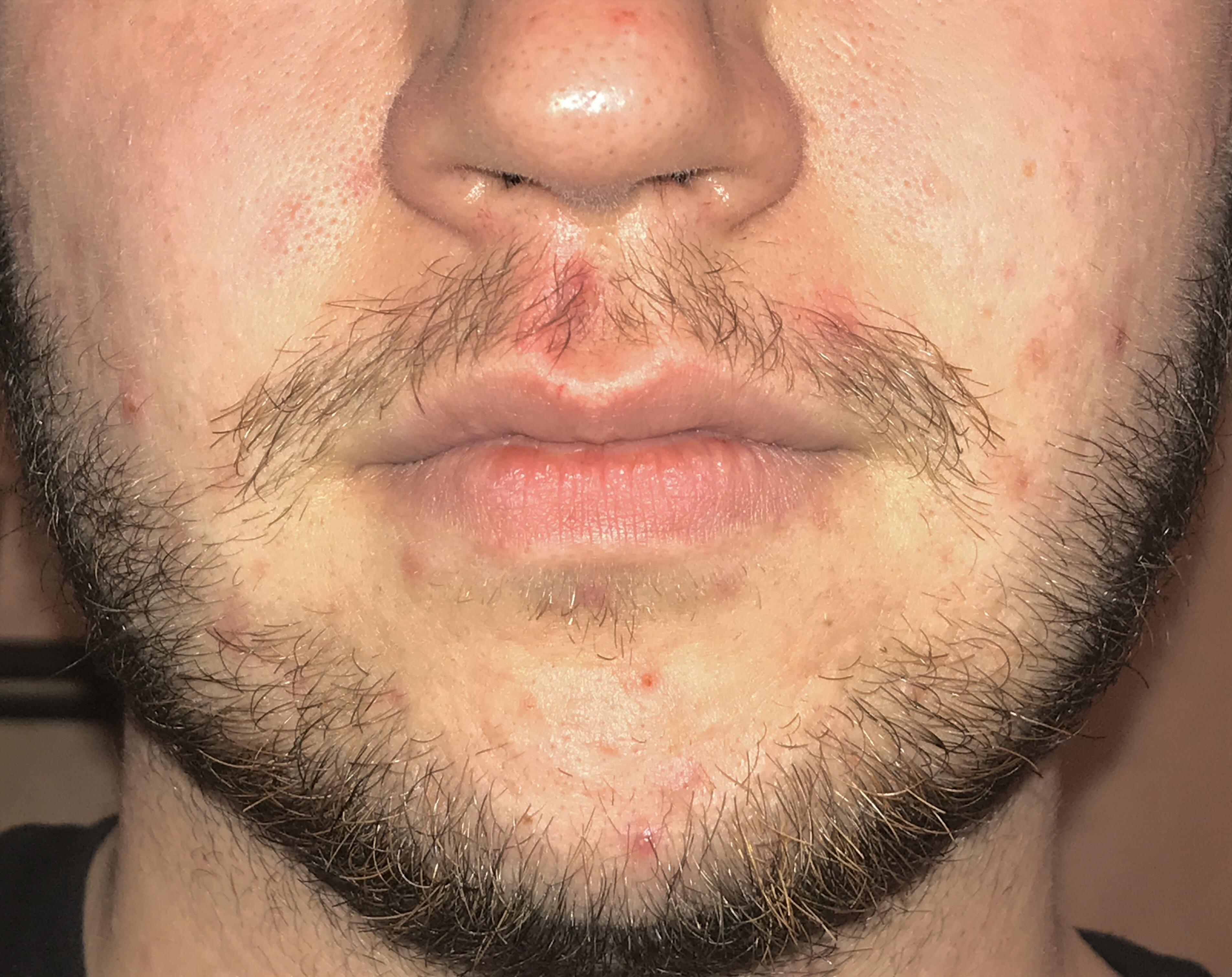 Minoxidil to fill out moustache? I know the rest of my facial hair is