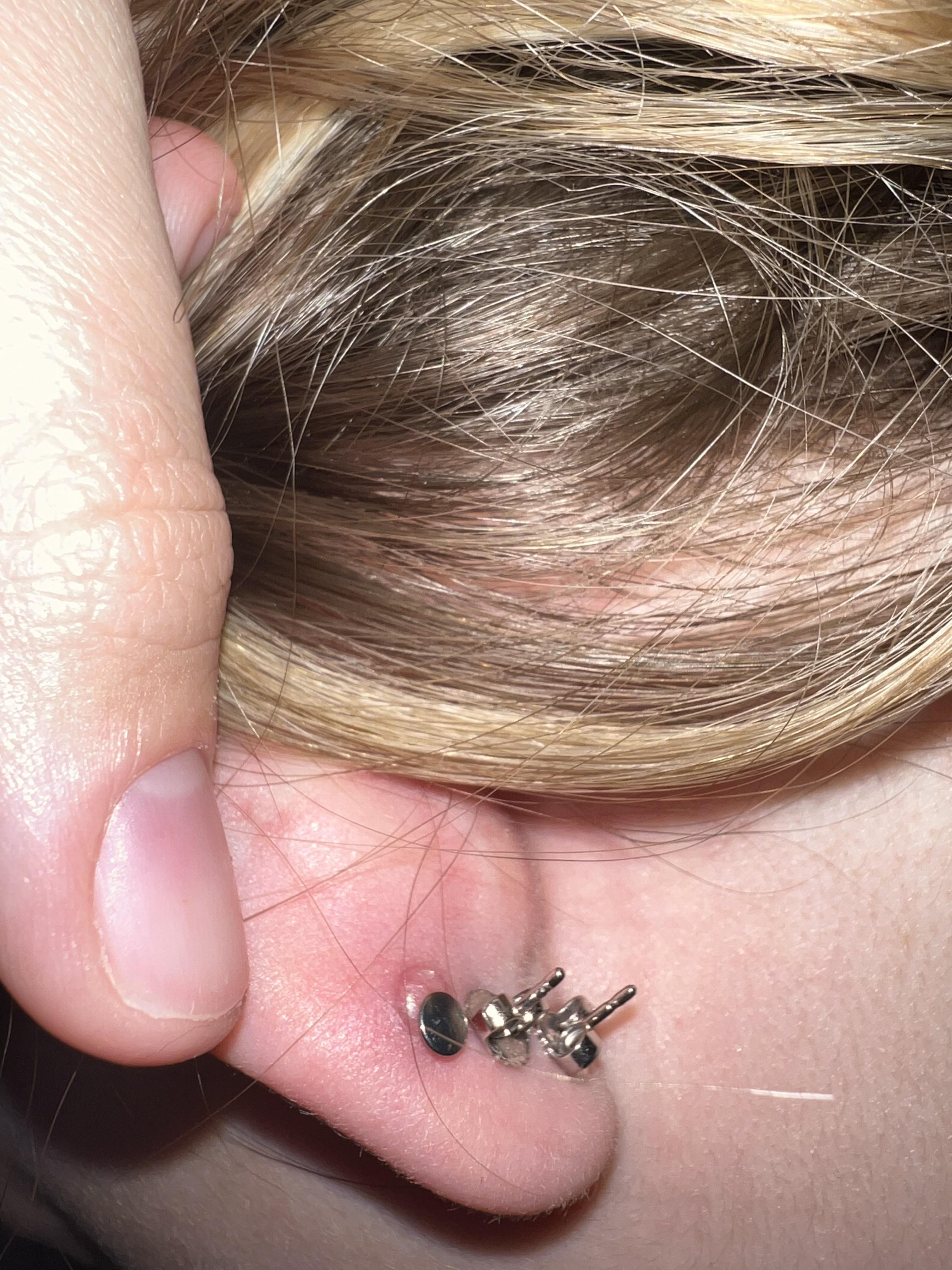 Does this look like a keloid or piercing bump? What do I do to help it