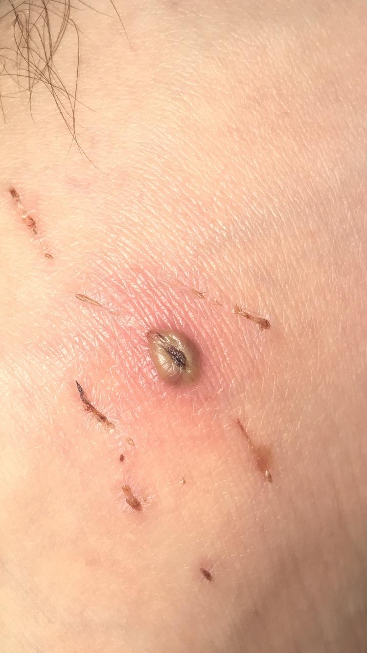 Cat scratch disease brewing. CatsAreAssholes