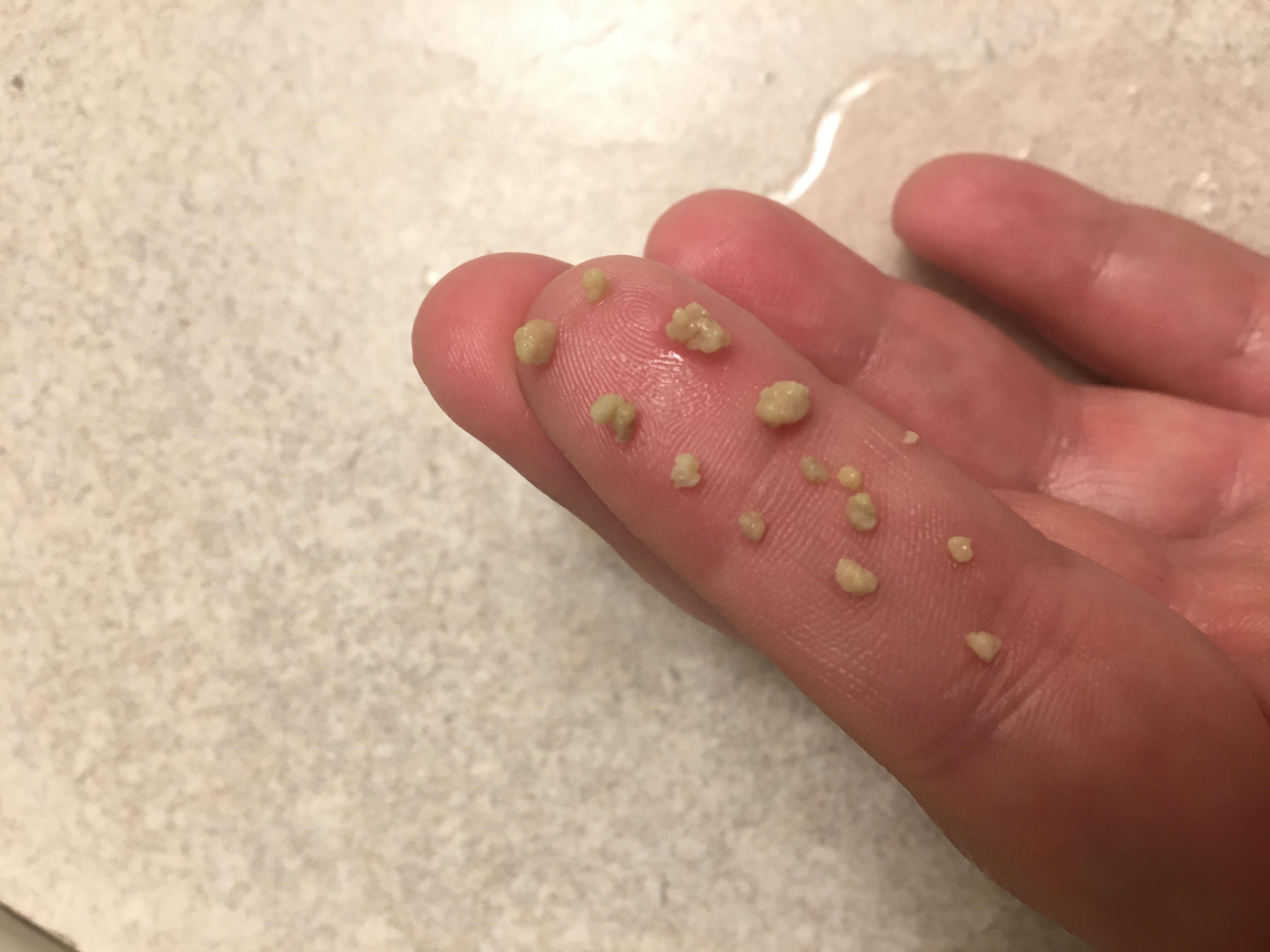 Best Mouthwash For Tonsil Stones Reddit Tonsil Stones Rid Gargle Permanently Ways Natural Salt