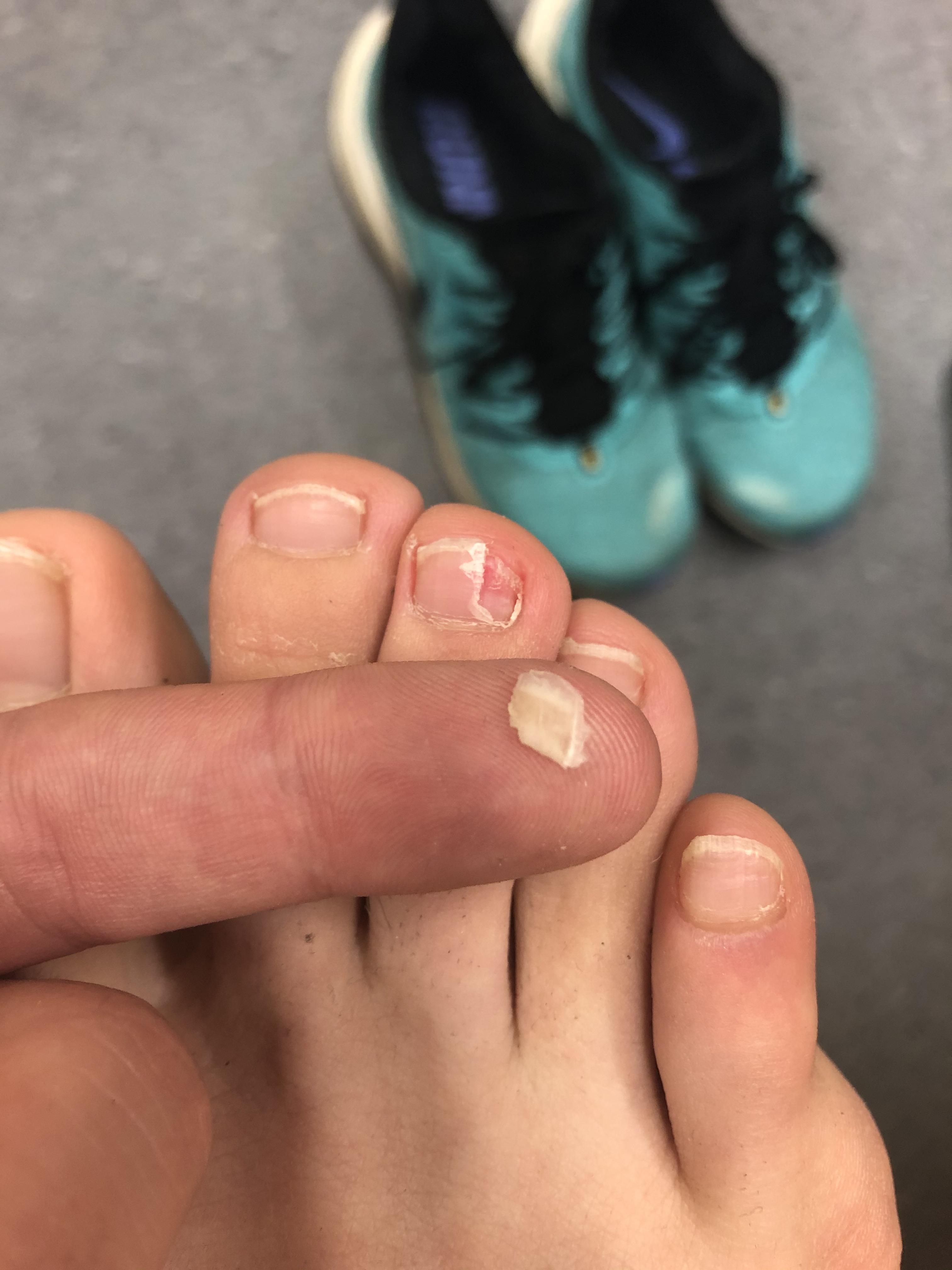 Runner toenail. Not ingrown but I was extremely satisfied for how