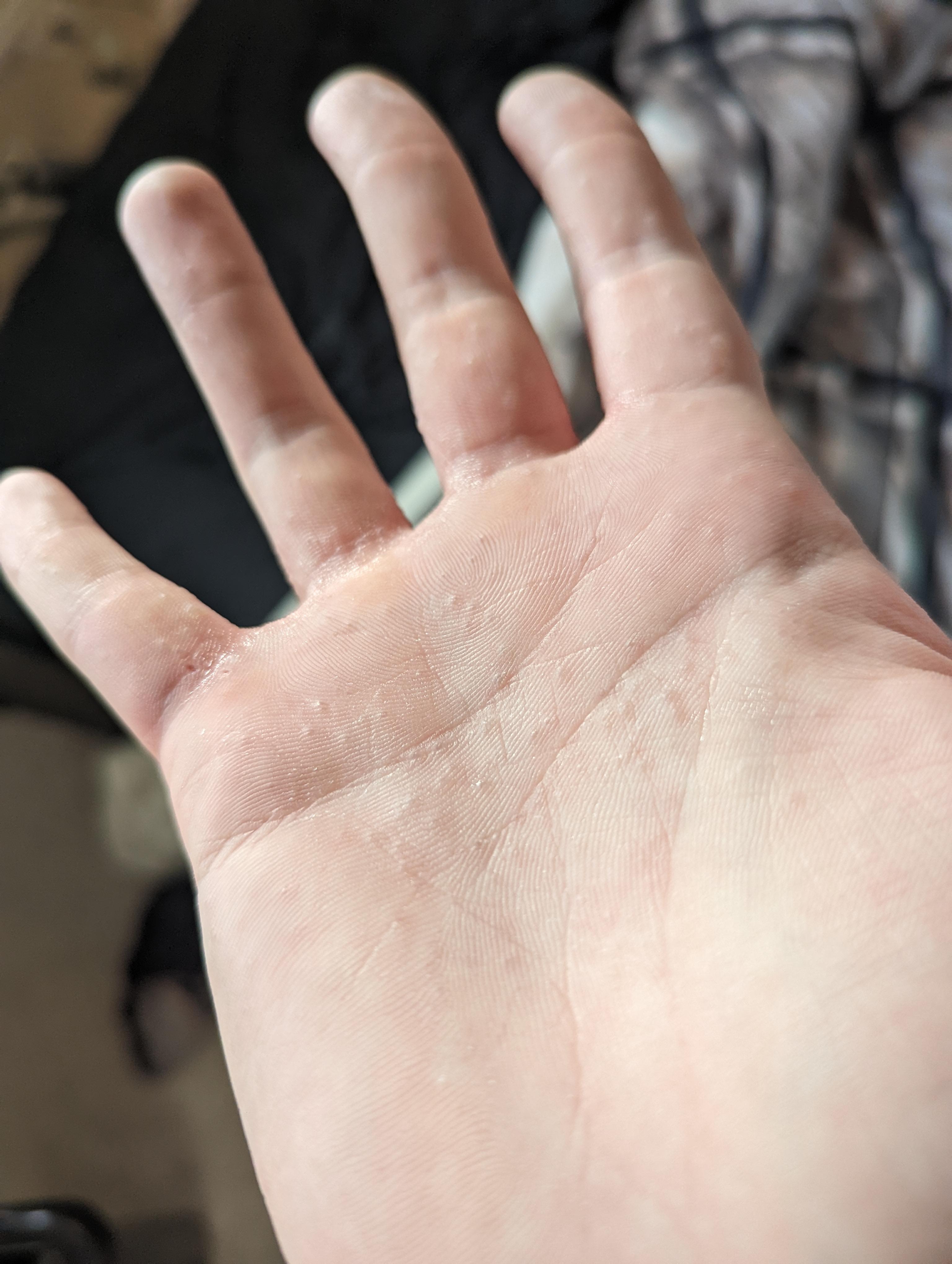 woke up with a ton of itchy blisters on the palms of my hands, never