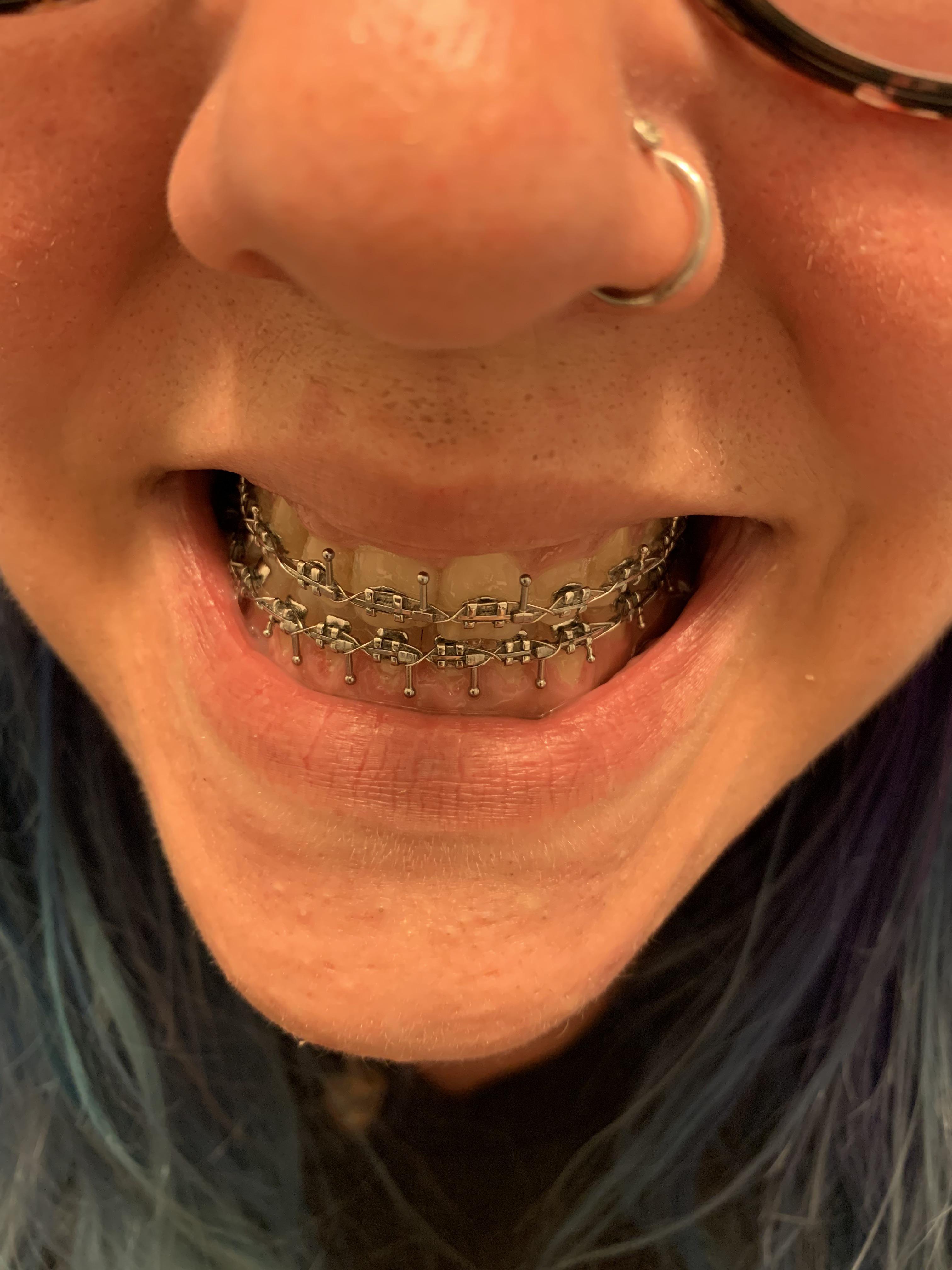 Had surgical hooks placed yesterday in preparation for jaw surgery on