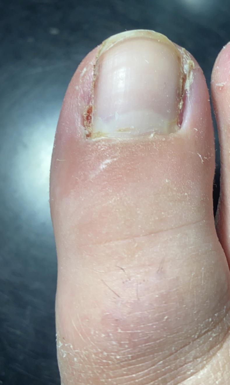 After my nail avulsion procedure. (3 weeks post op). r/Ingrown_Toenails