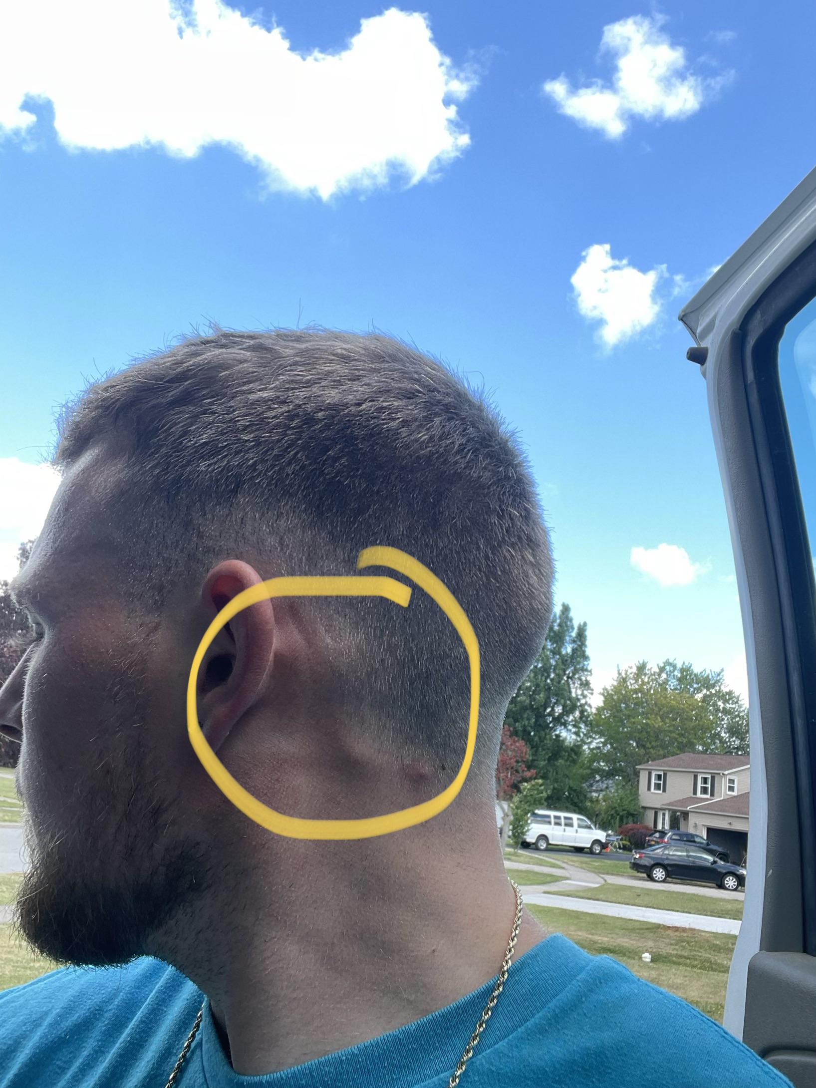 My pimple turned into a pea size lump after popping it. Any way to