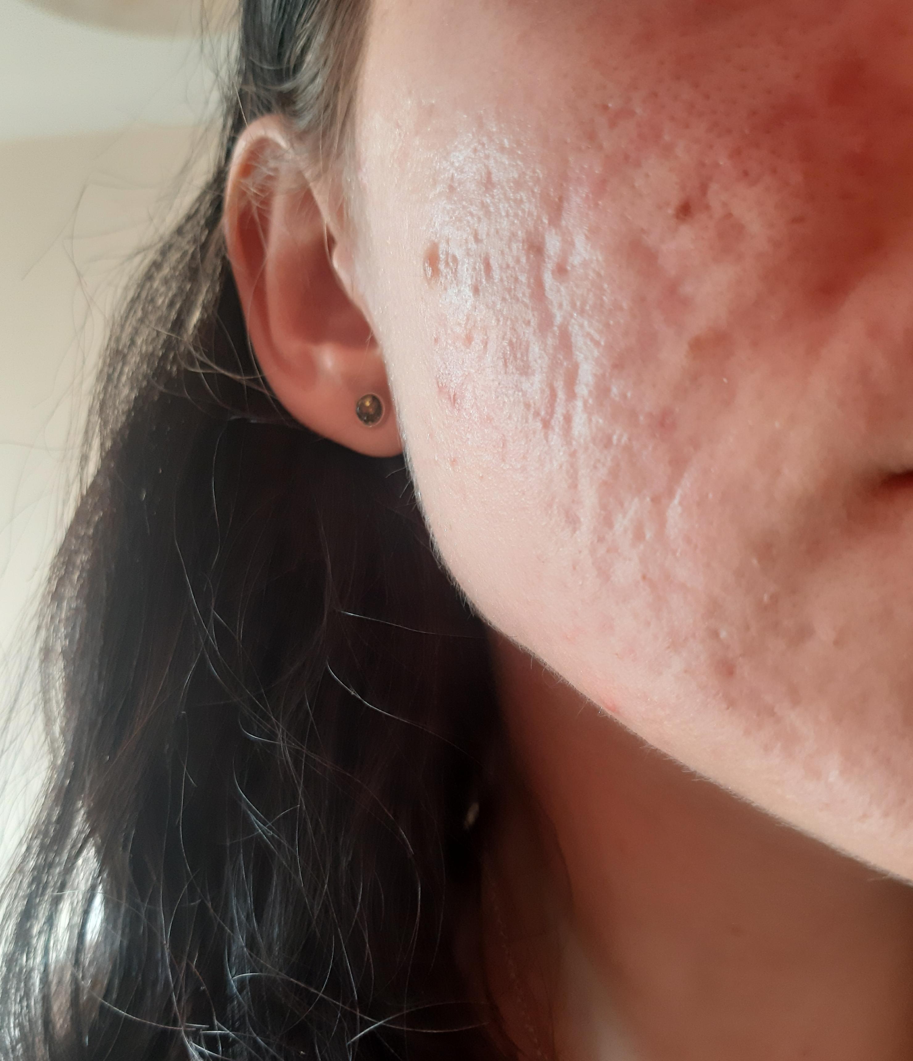 Hi! First time poster here. 7 year long battle with acne ended with