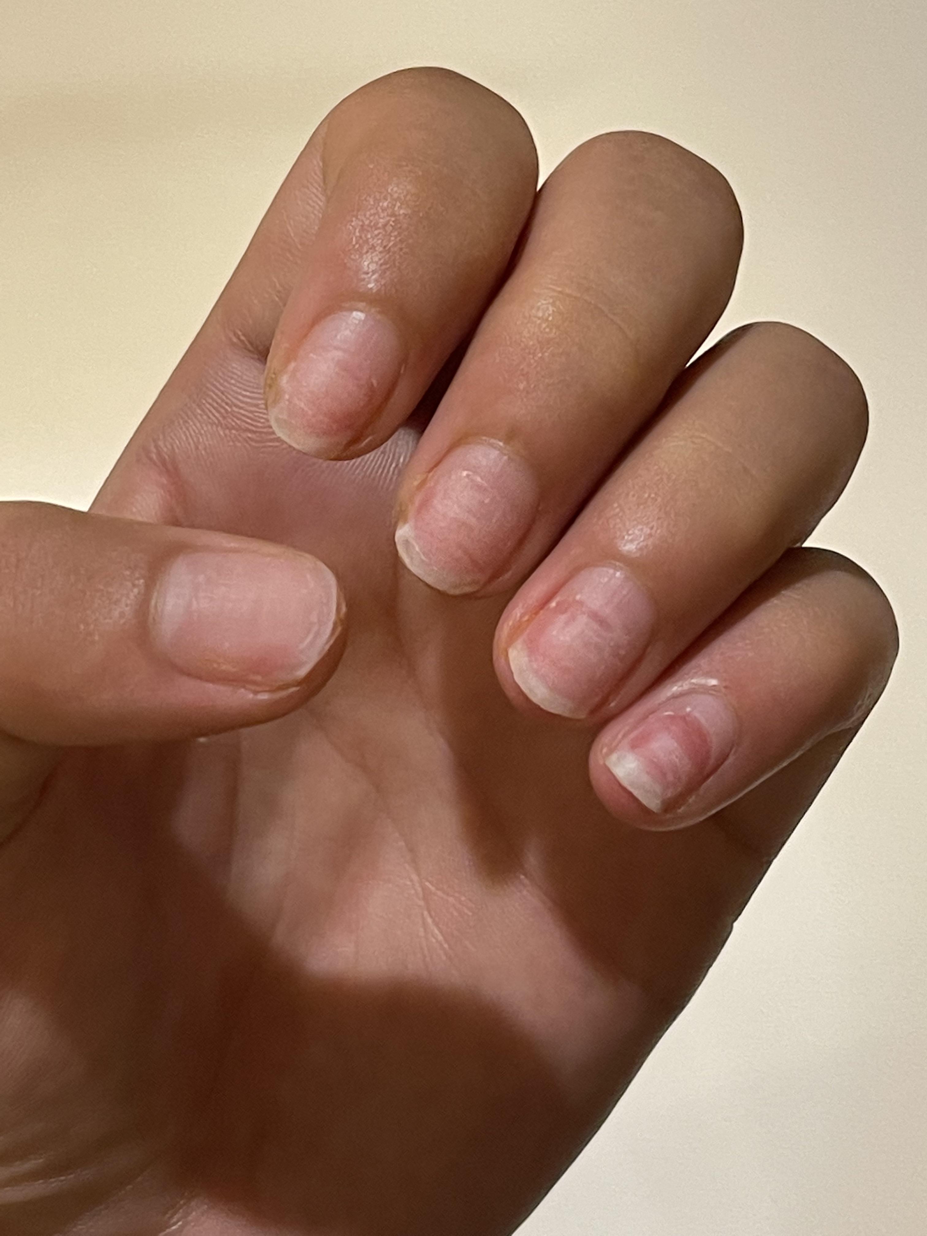 Nail tech used efile to remove acrylic and went too far, worried