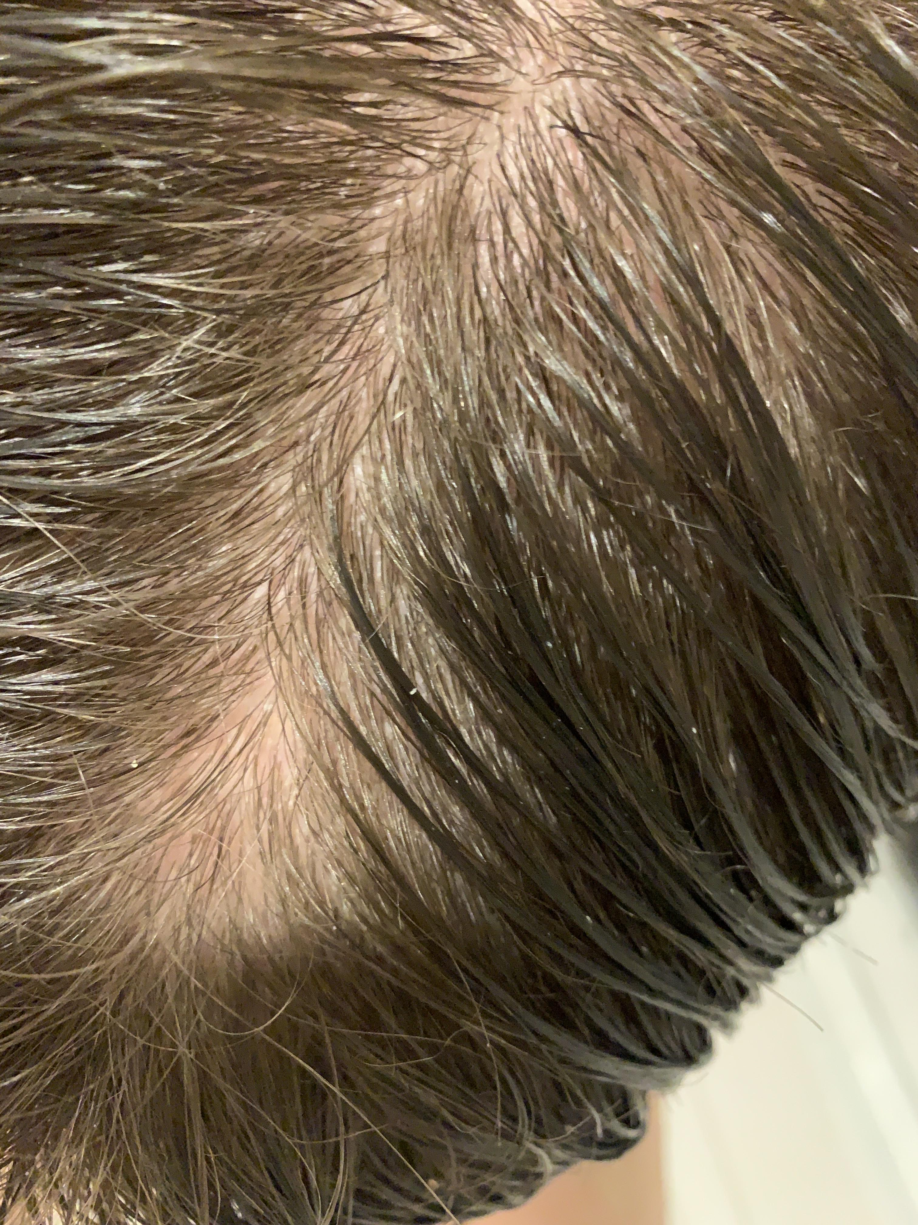 Does it look like I have telogen effluvium or am I just paranoid